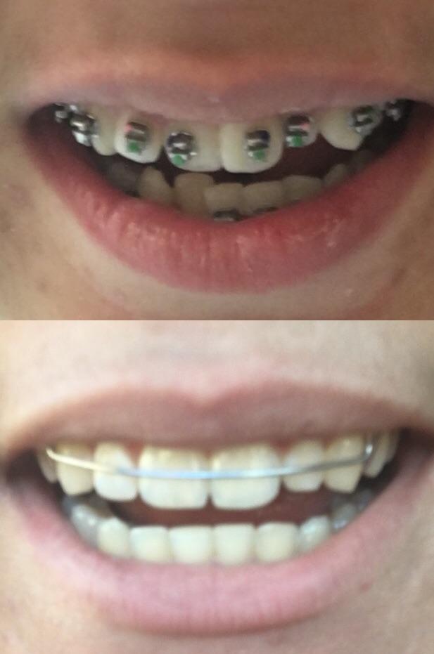 After two years I got my braces off today!! Fixed my jaw problems