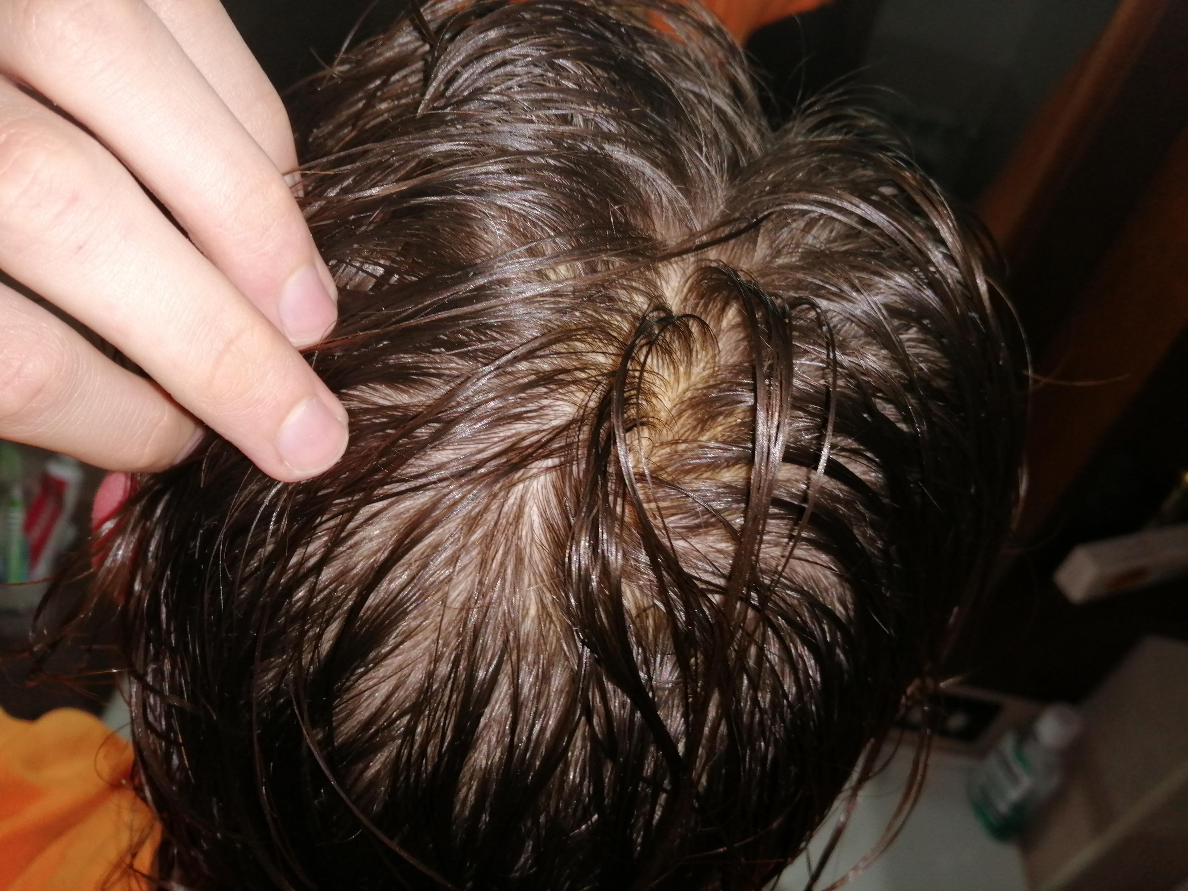 Yellow patches on the scalp(what are they and how to solve them) r