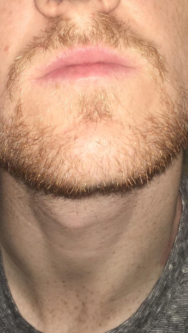 Chin patch? Anyone with something similar and if so how did it fill out