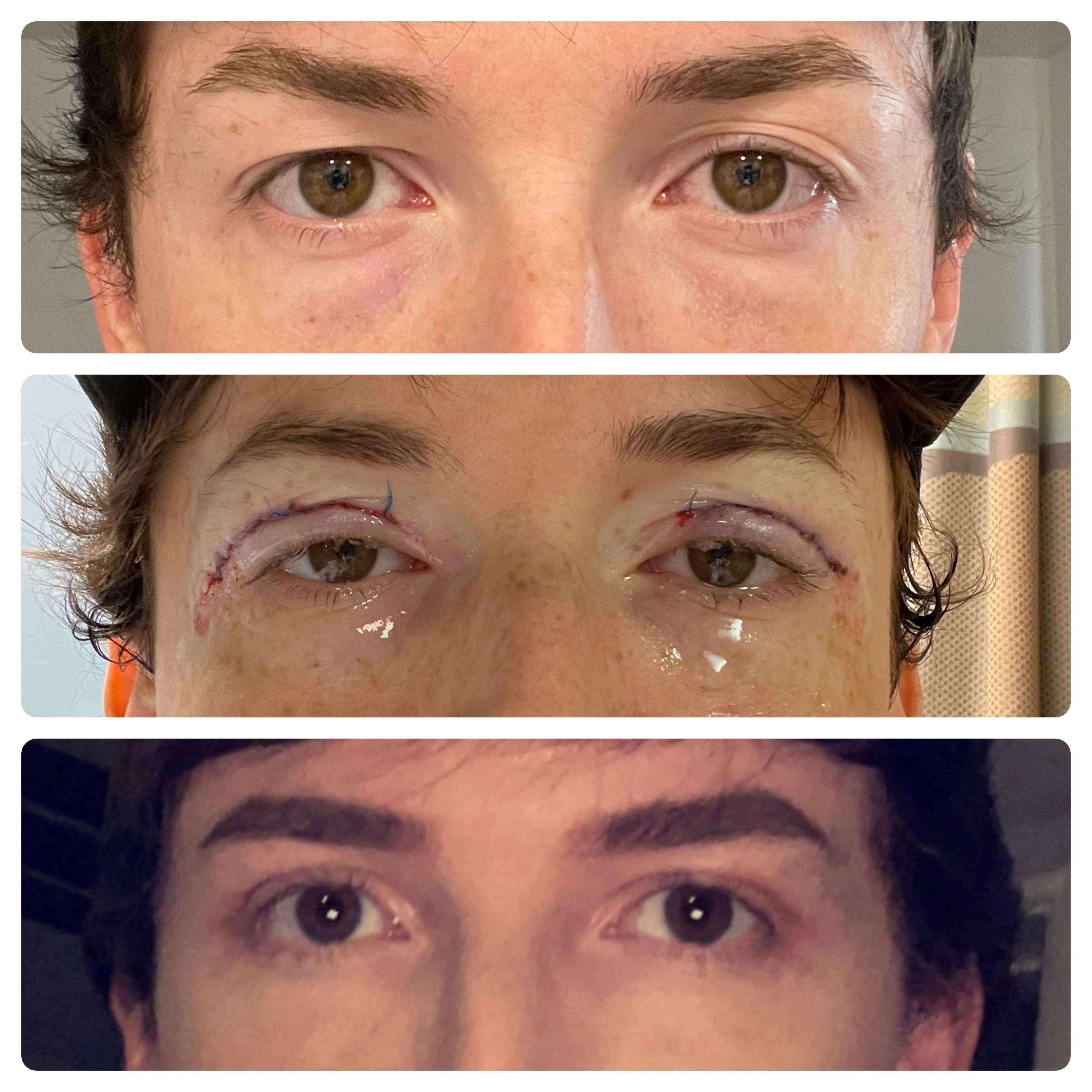 I’m a 27 year old cis male who underwent upper bilateral blepharoplasty