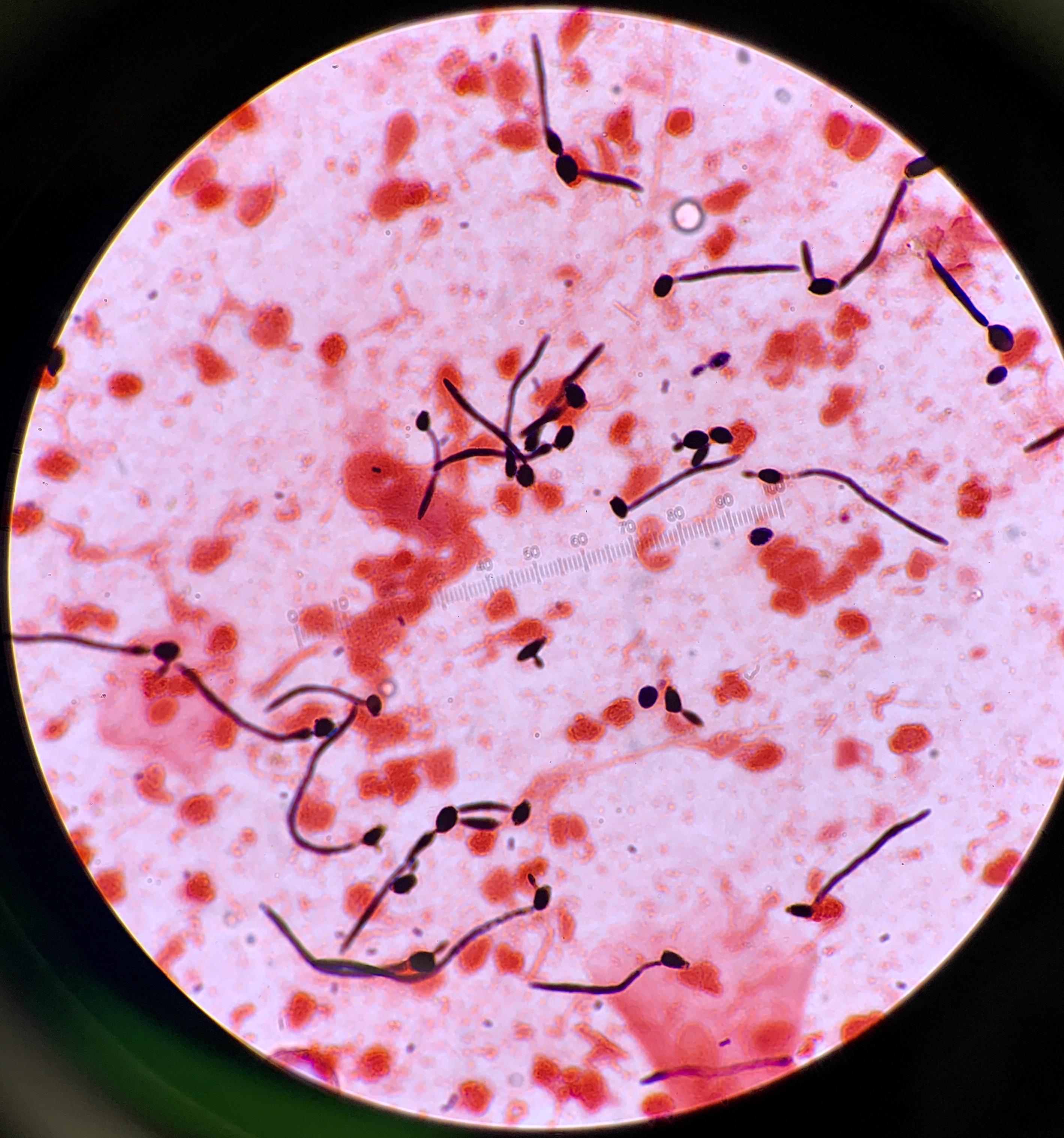 Yeast having a party in a patient’s sputum Gram stain. r/microbiology