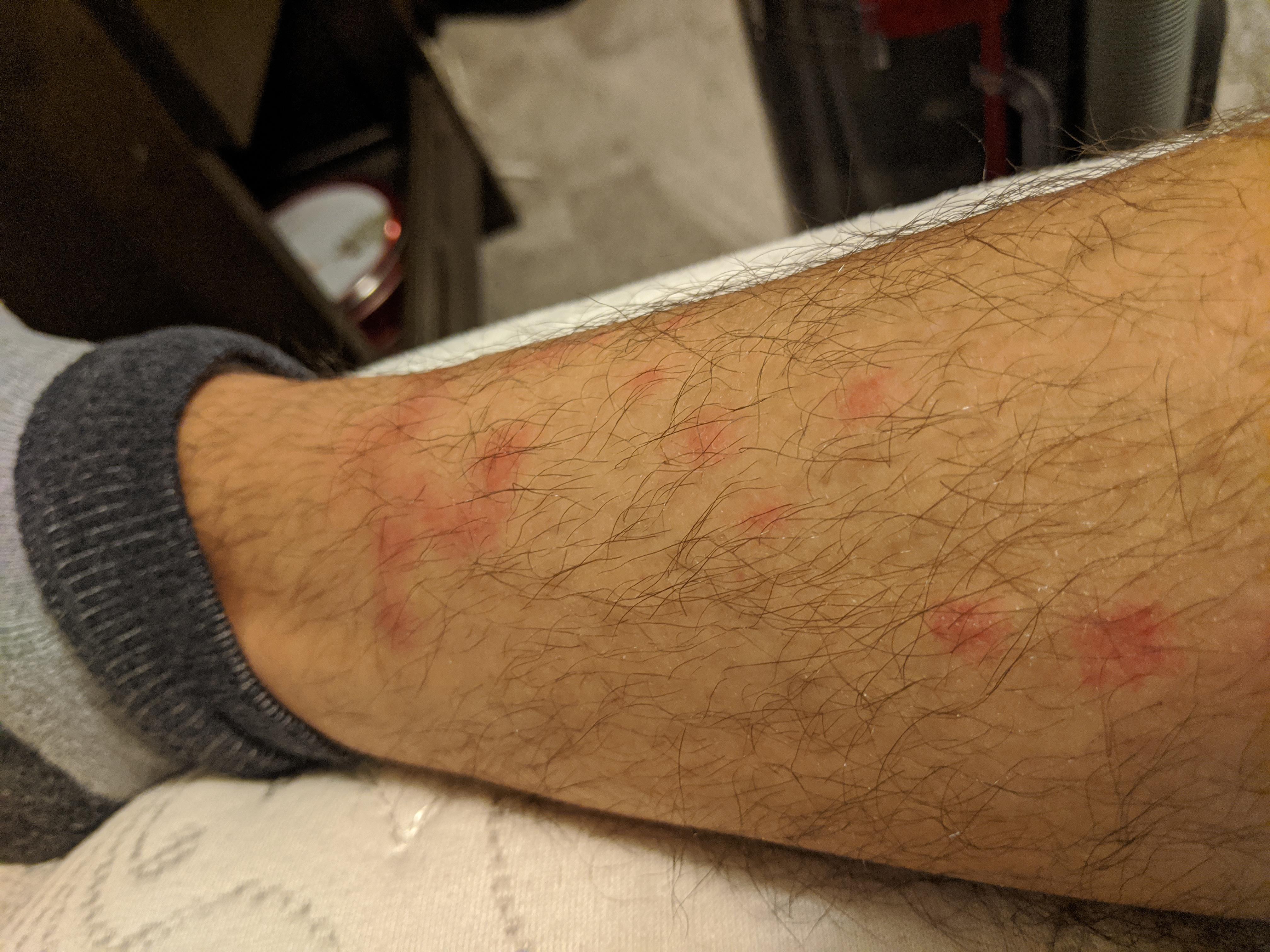 Are these bed bugs? No signs of them in room r/bugbites