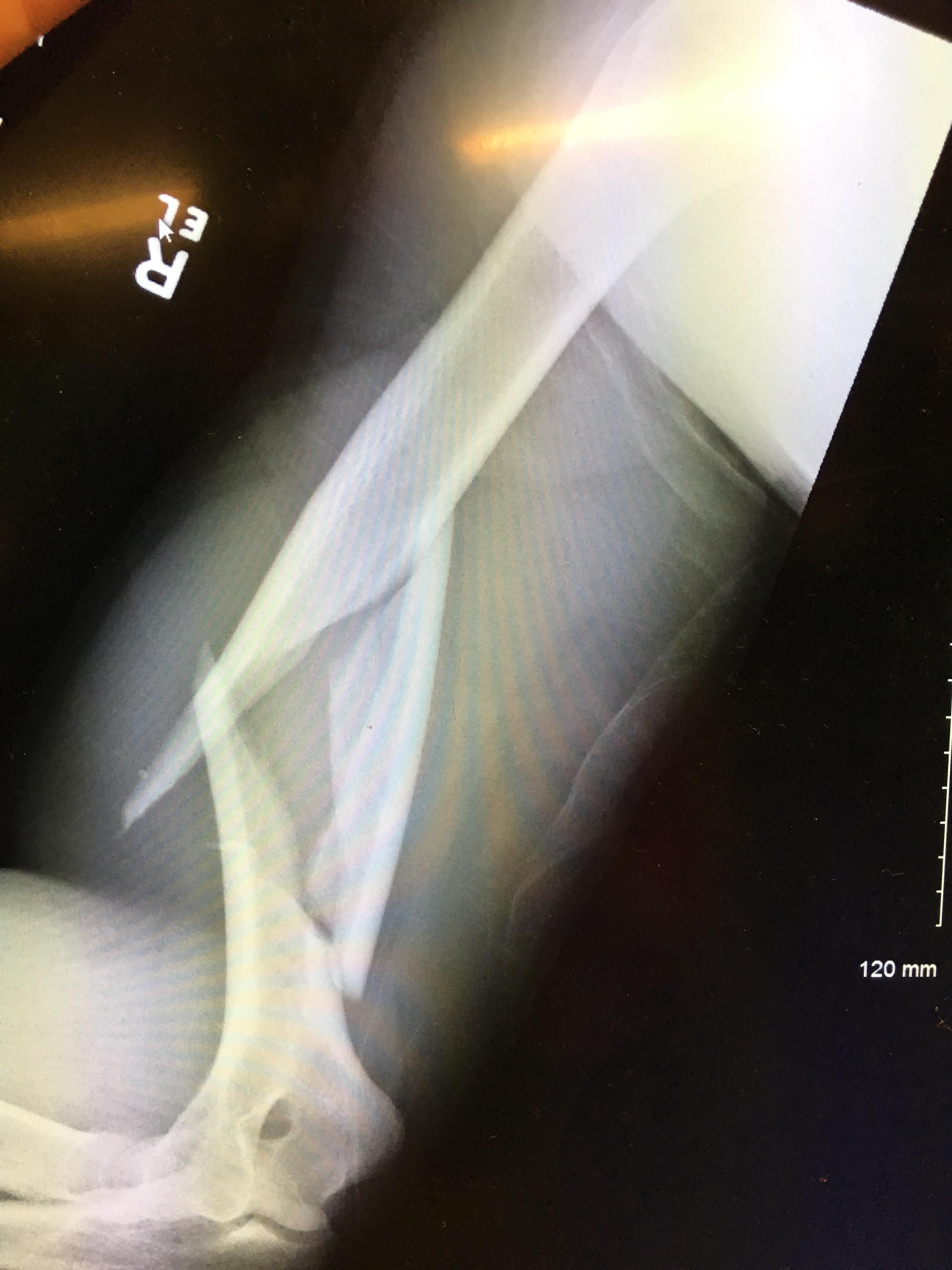 Fracture patient sustained from pitching a baseball r/medizzy