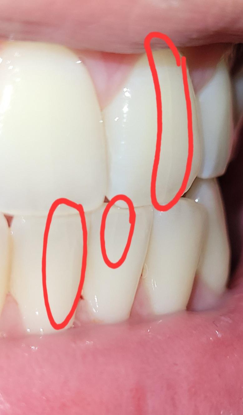 Are vertical lines in your teeth a normal thing? More in comments r