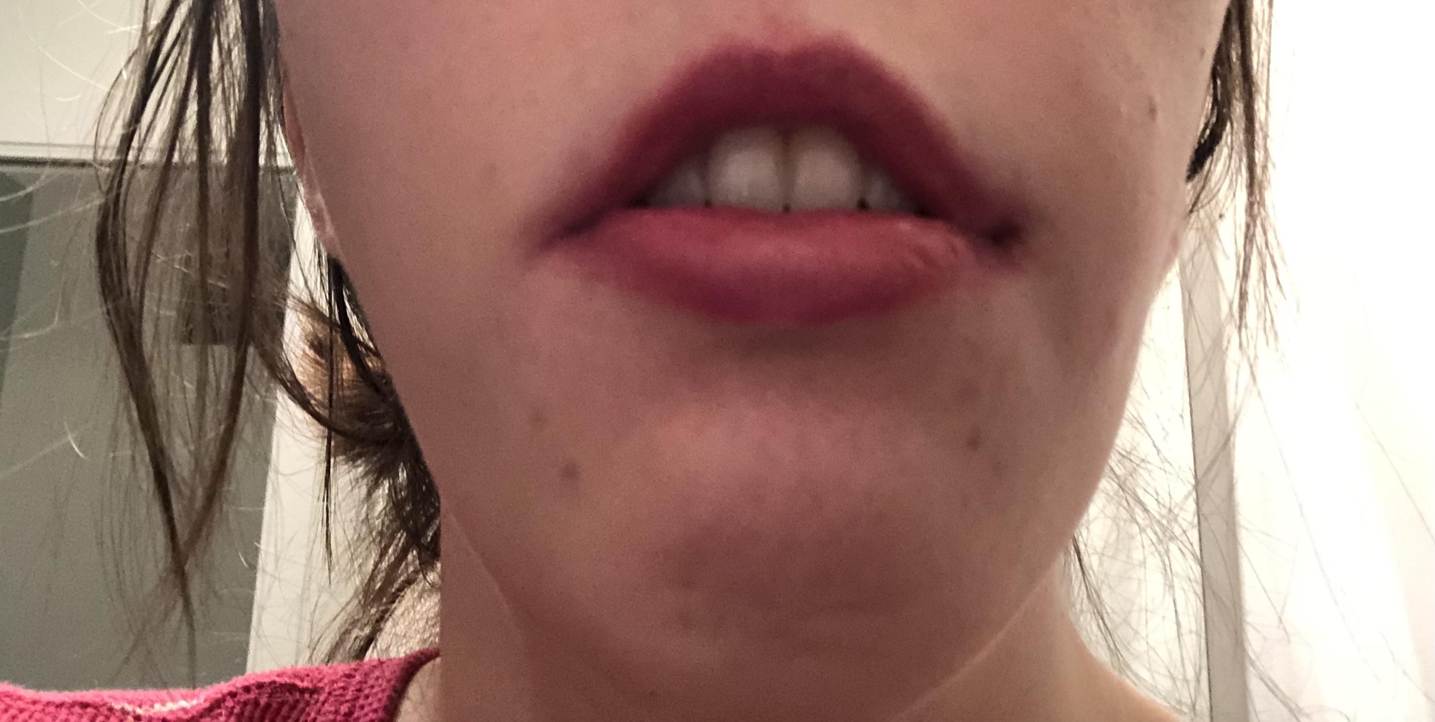Lip any options besides jaw surgery? I am scared of complications especially nerve