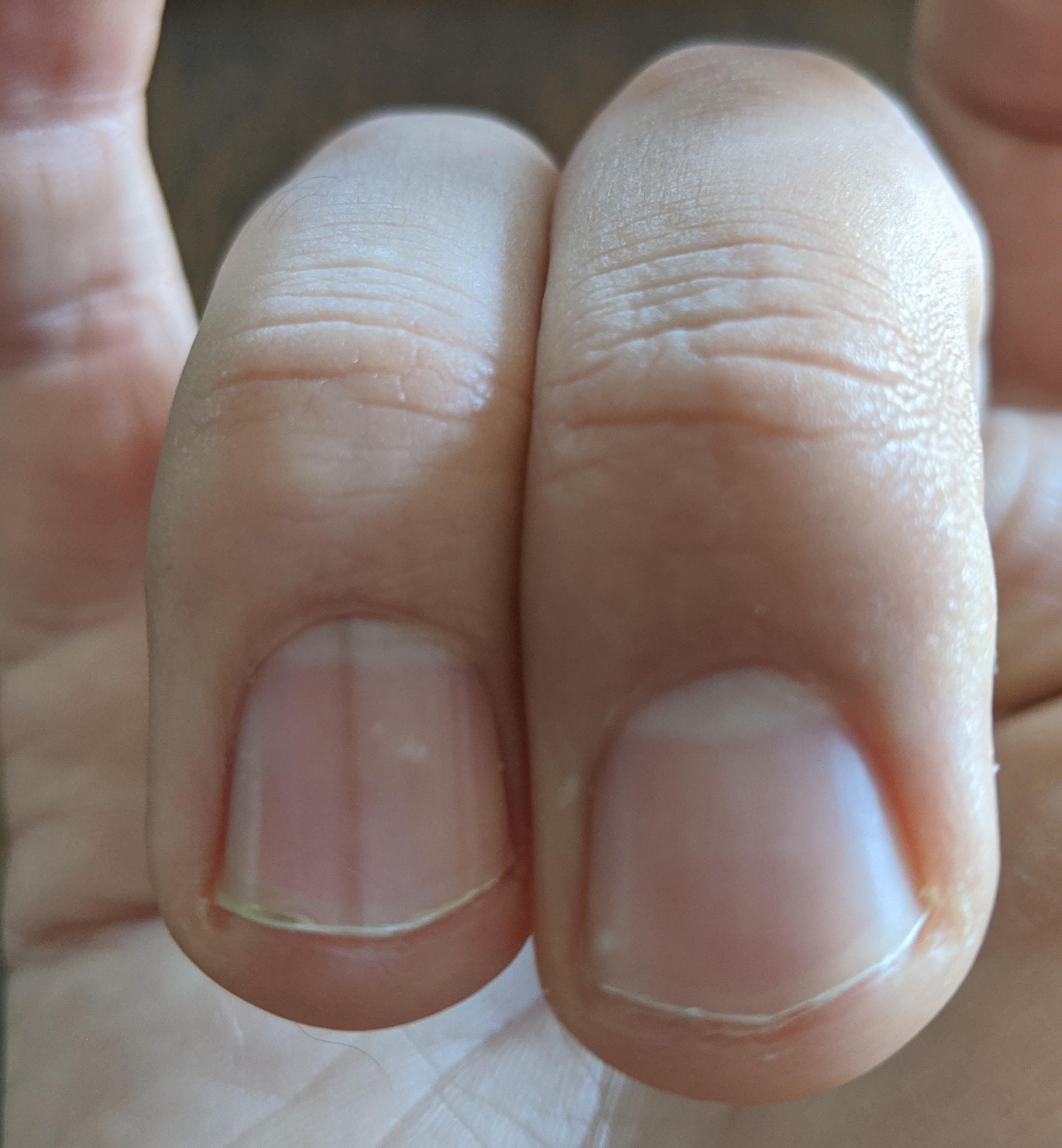 Longitudinal melanonychia causing a dark stripe on my fingernail
