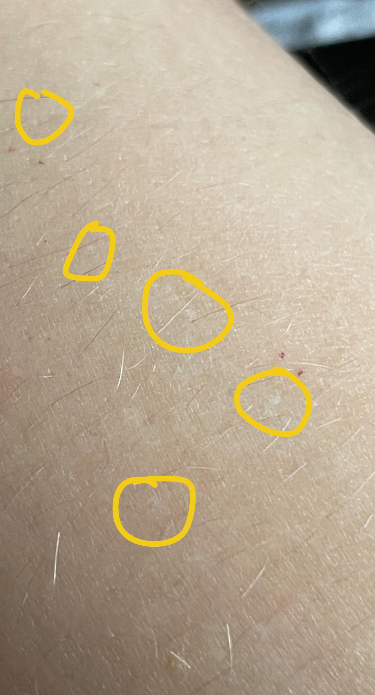 Skin Concerns] I Have These Tiny White Dots On My Skin, Which Are Presumably From Sun Damage, But I'm Only 19—Is This Normal? My Mom And Dad Both Don't Have Any On