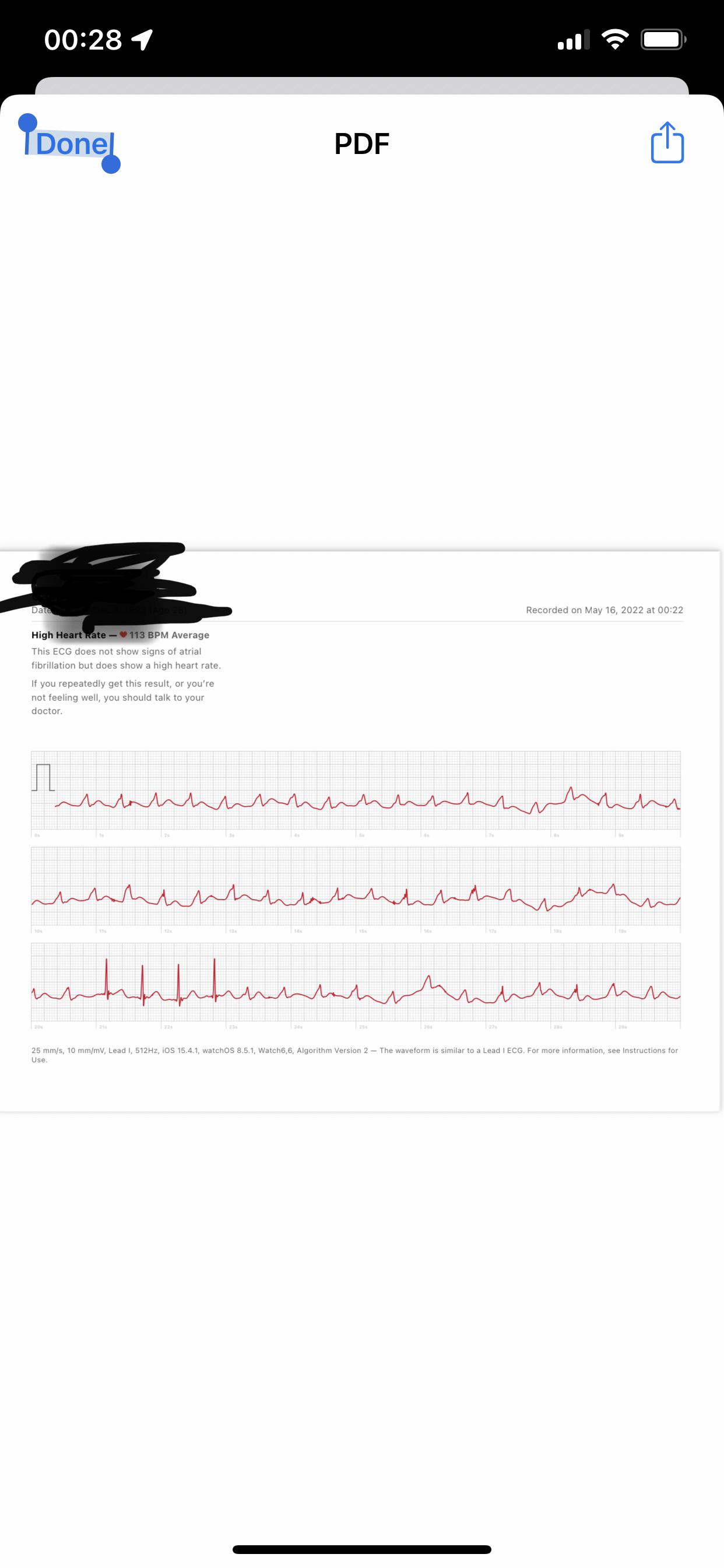 28f with pacemaker. Hx of ablations Svt and afib. Can’t interpret this