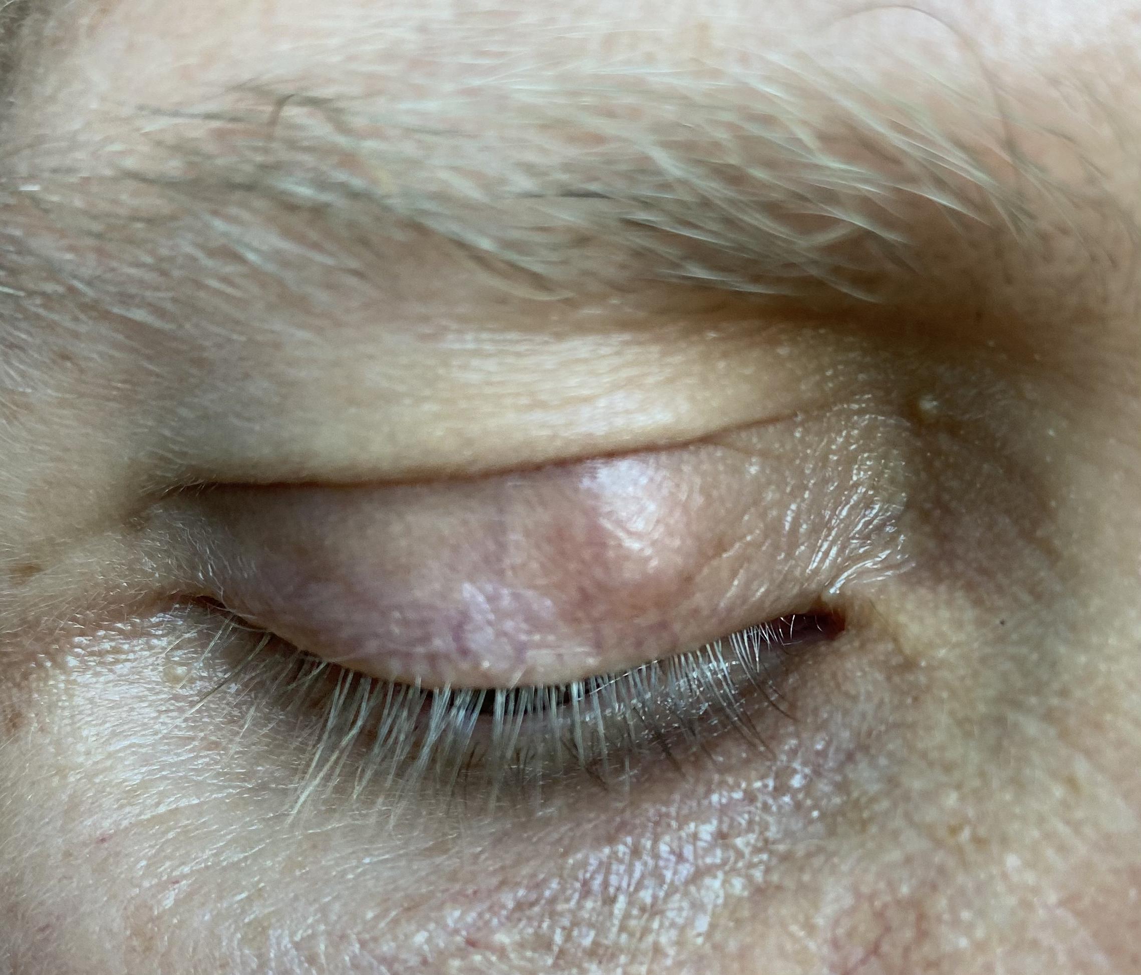 If I have chalazion scar tissue can I wear contacts/makeup? eyetriage