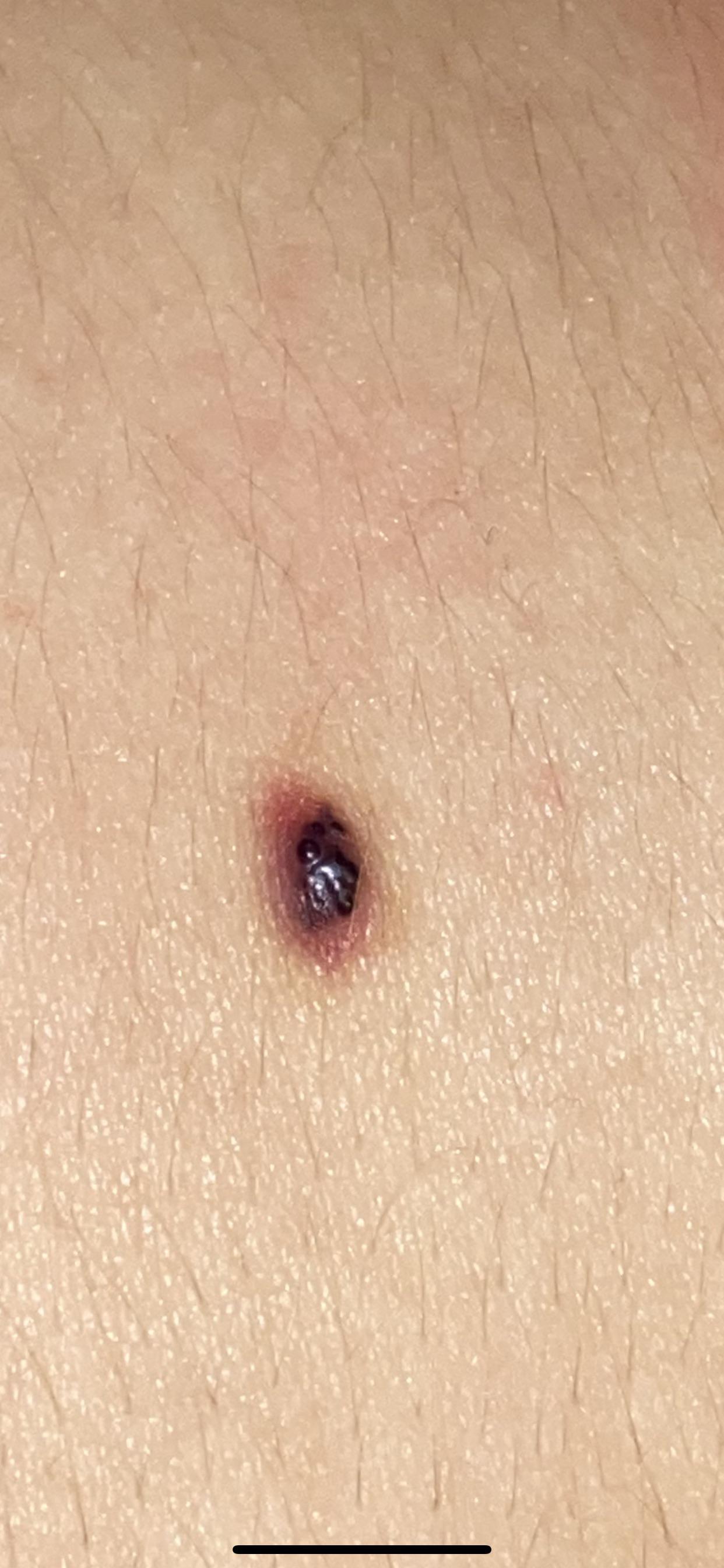 Blood blister? Or should I go get it looked at??? r/Melanoma