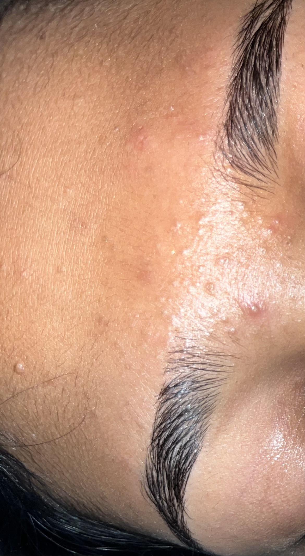 Arm acne or something else?