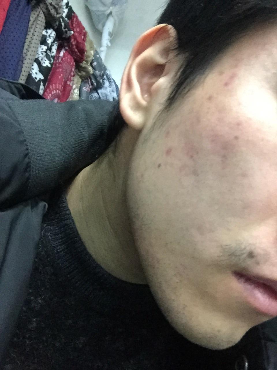 [acne]how to fade those dark spots on my face? r/SkincareAddiction