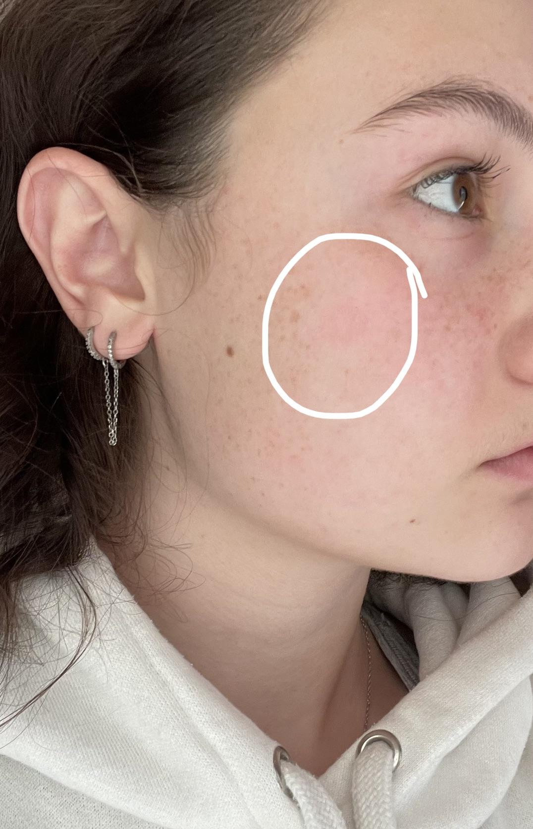HELP with curling iron burn mark/ scar [misc] r/SkincareAddiction