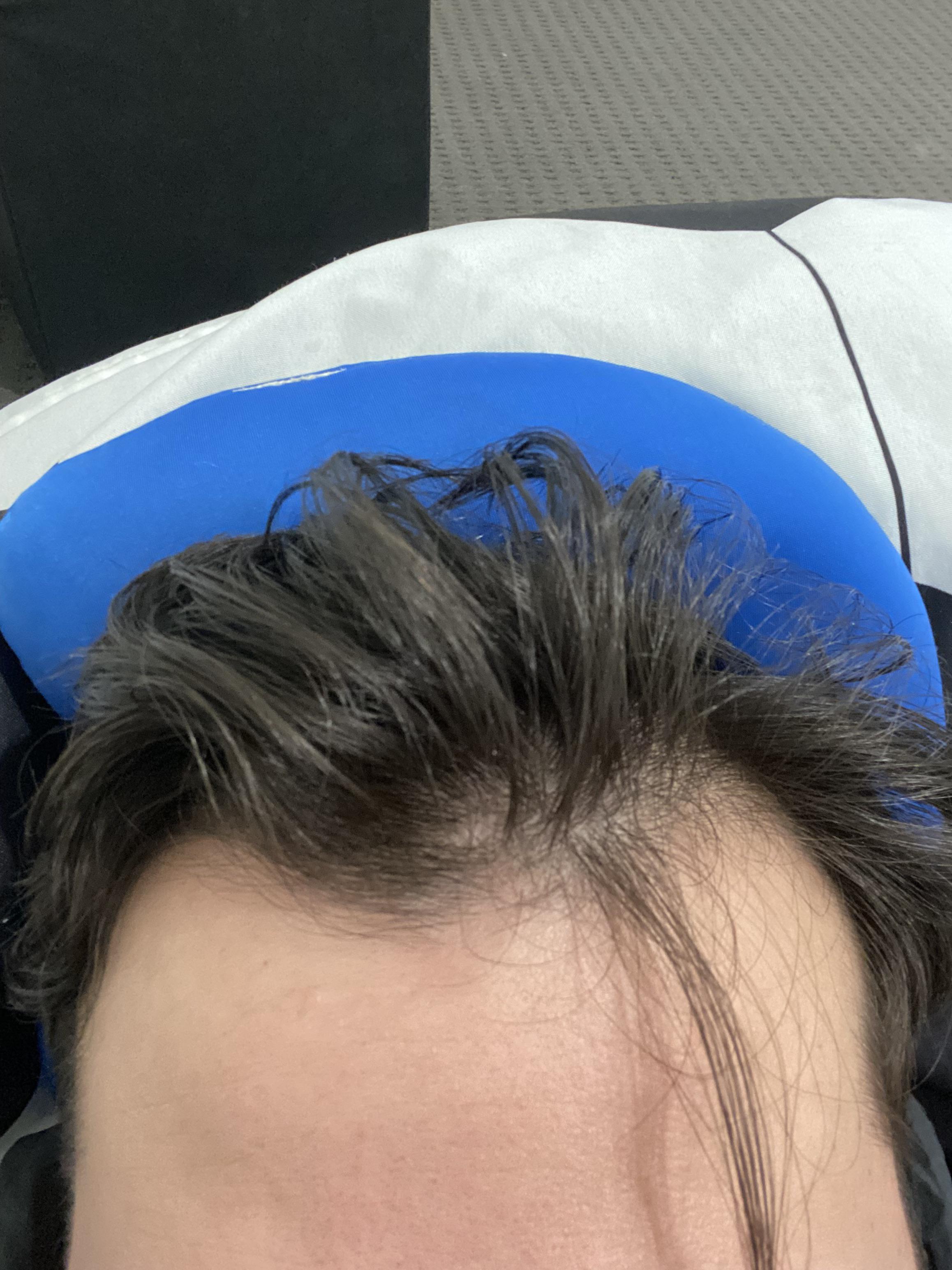 Hair is extremely thin after restarting my fin usage? Is this