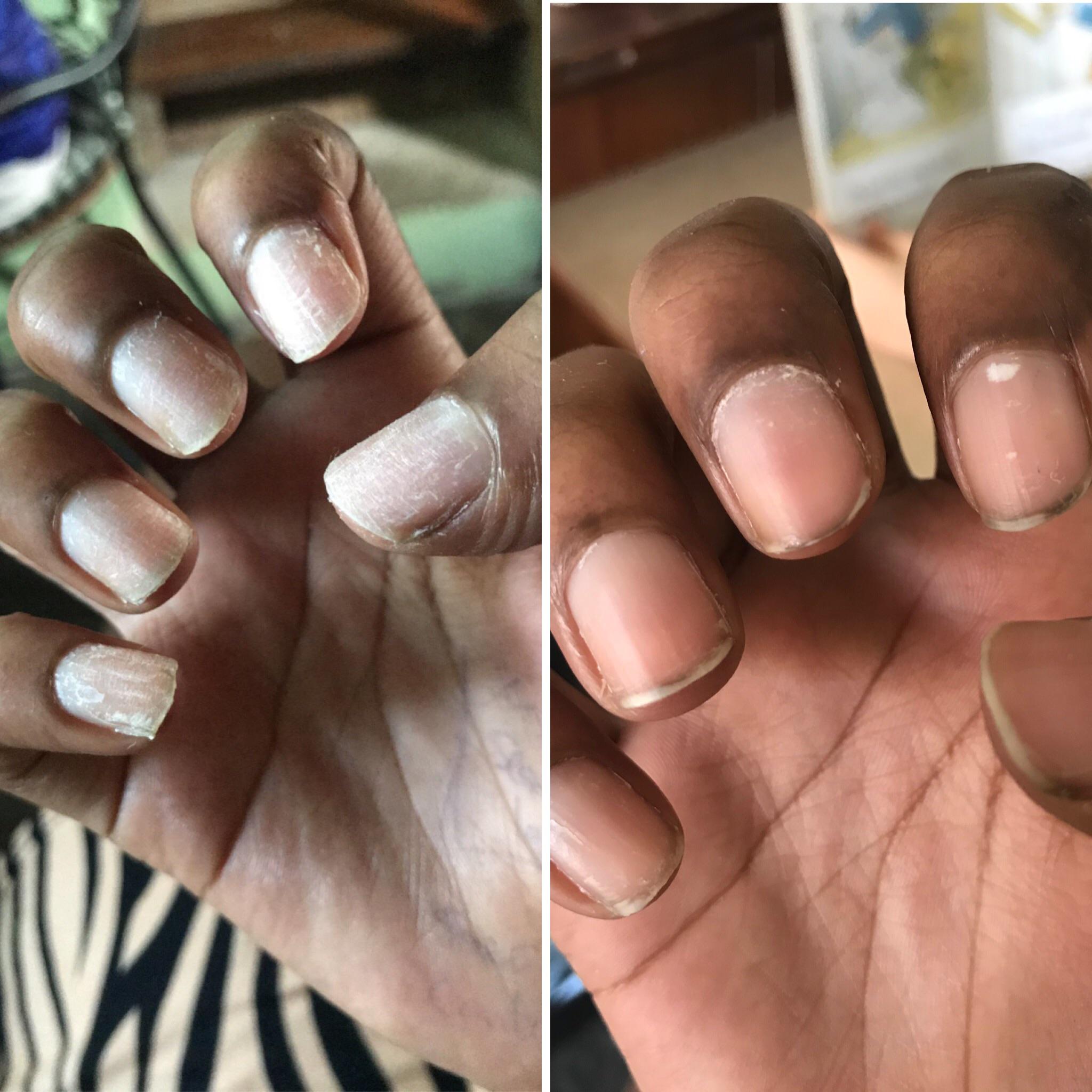 My nails were brittle/dry/damaged. A user under this sub