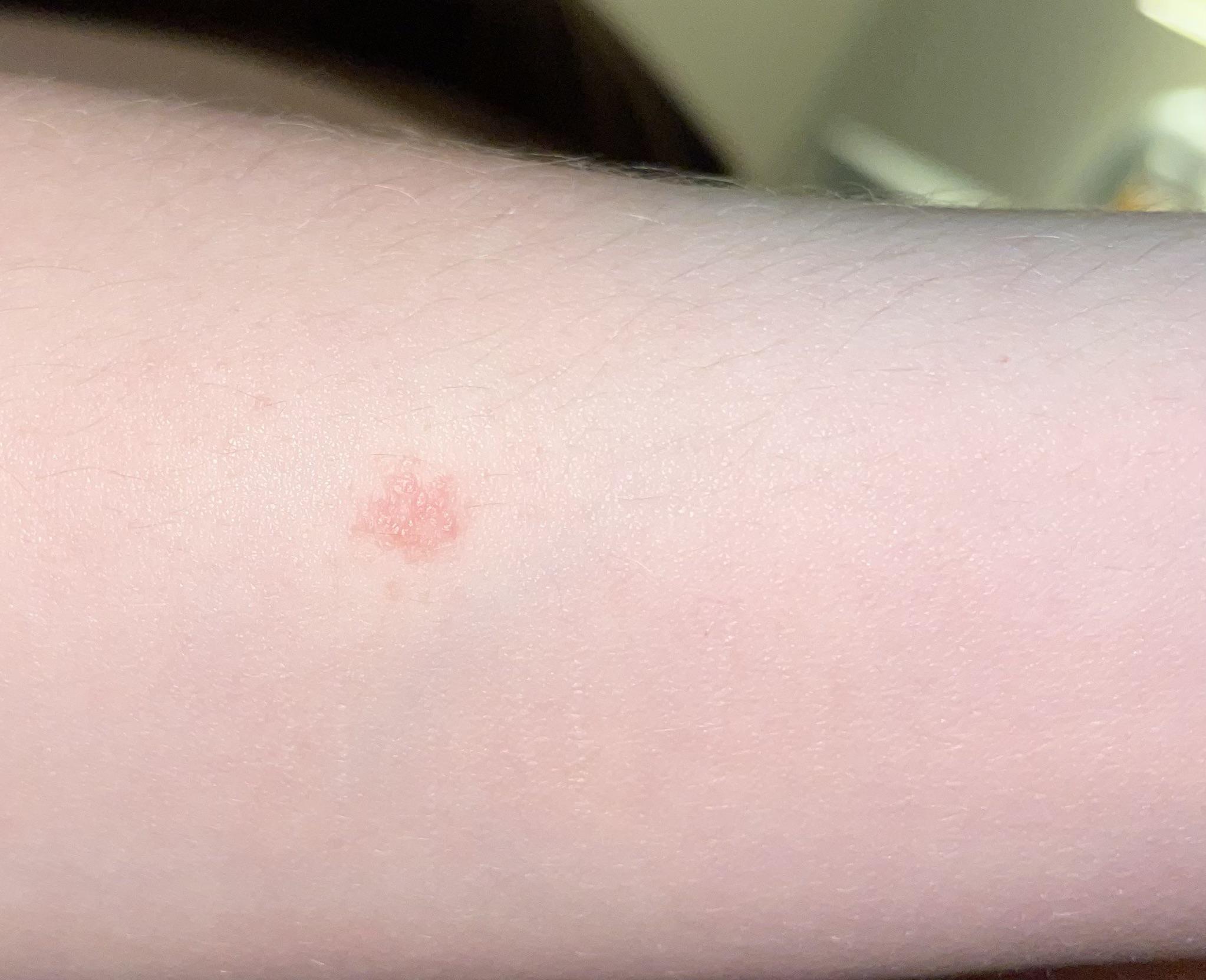 weird rash on arm. does anyone know what this could be ? its only in