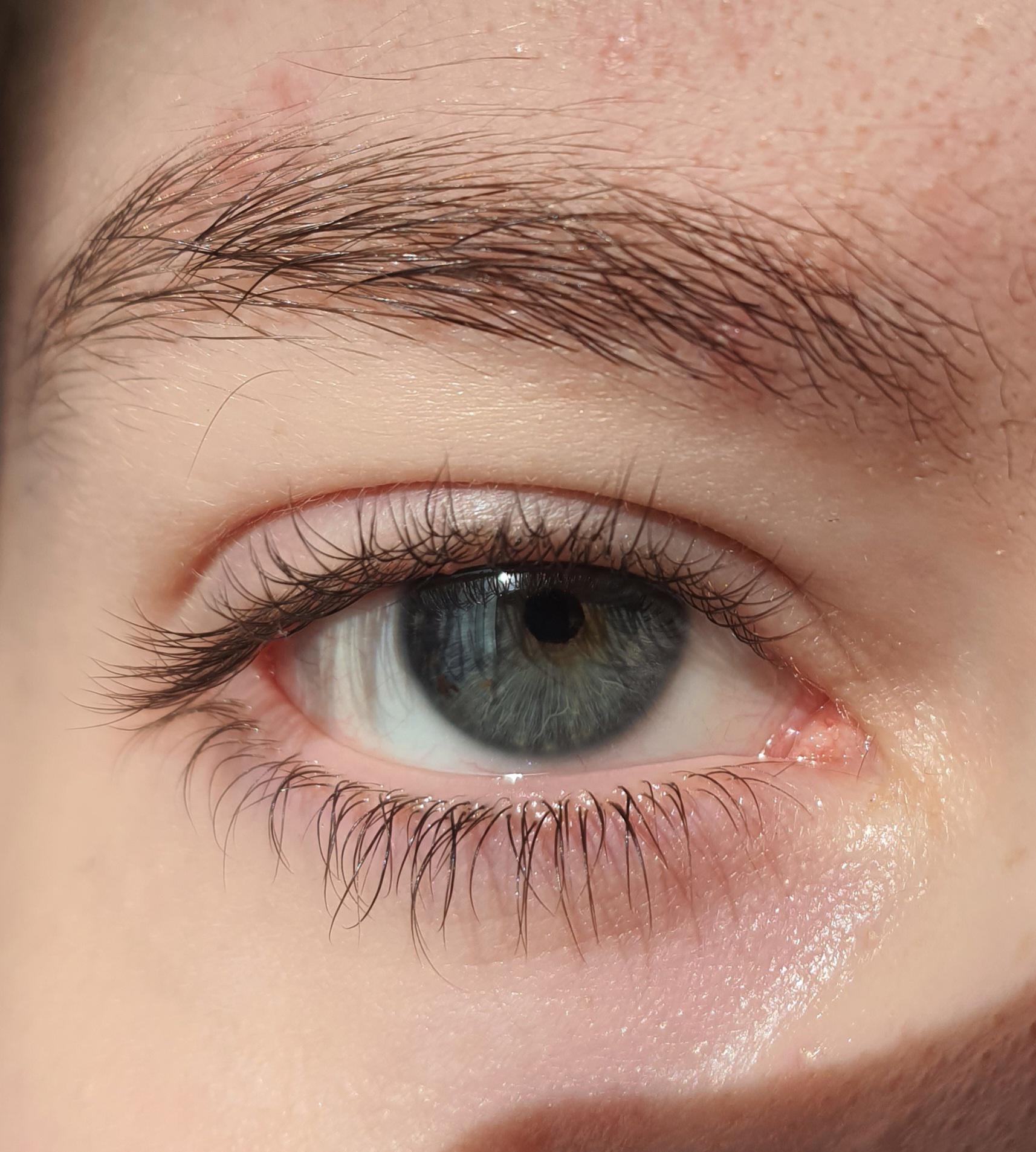 I am pretty sure the minoxidil application close to my hair line is