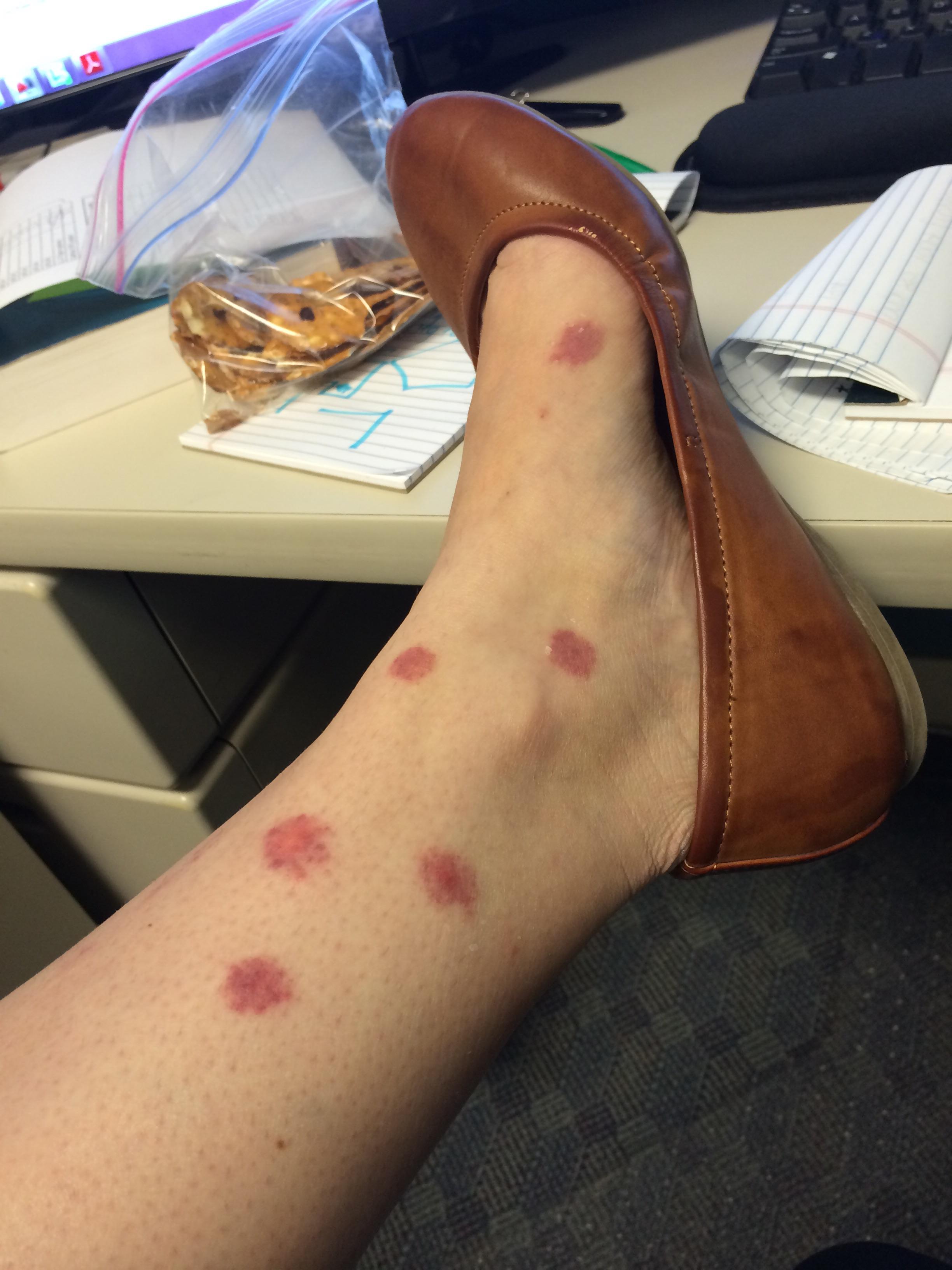 Mosquito Bite Allergic Reaction