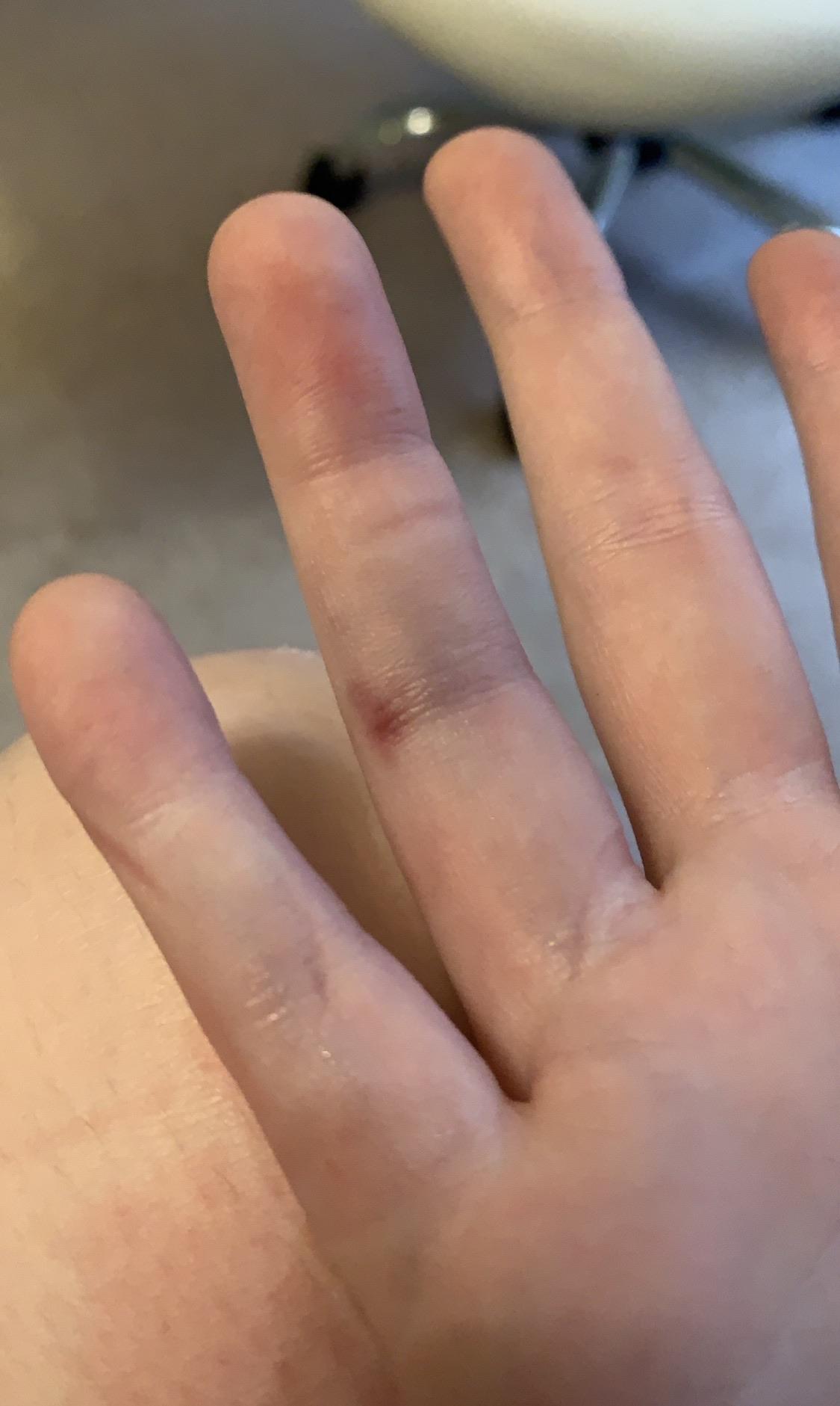 fractured my ring finger on a faulty set during a game the