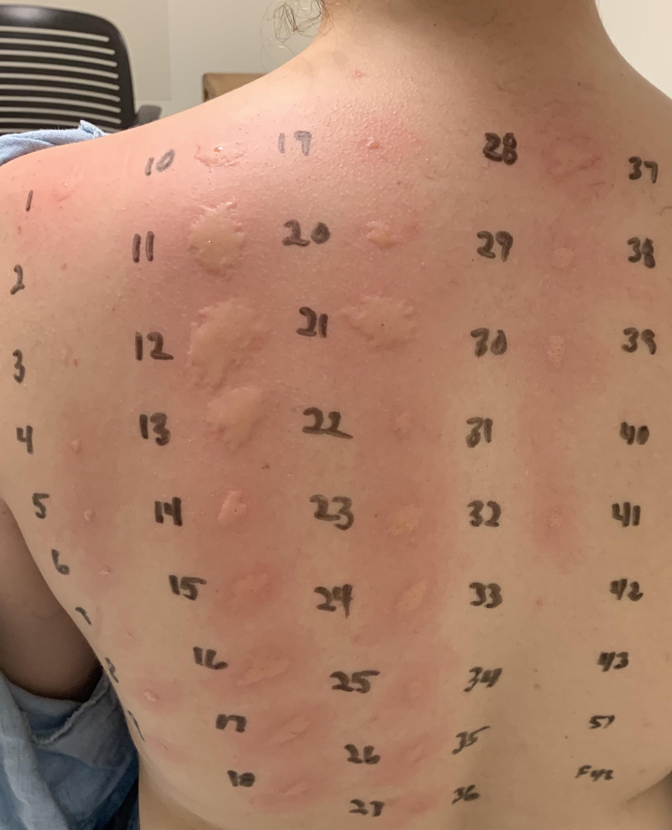 Well, at least I’m not allergic to molds? r/Wellthatsucks