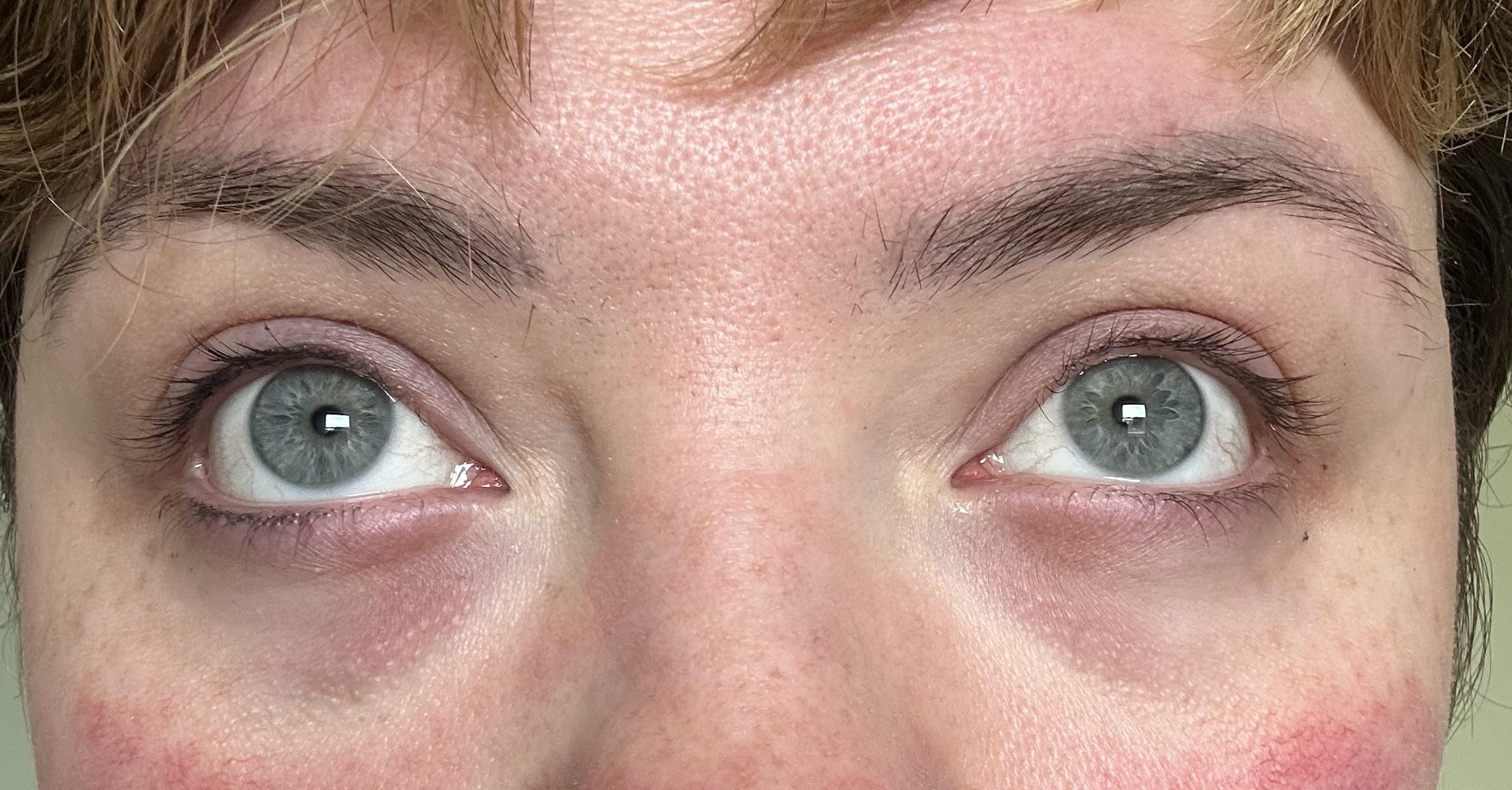 Hereditary Dark Circles…help! r/30PlusSkinCare