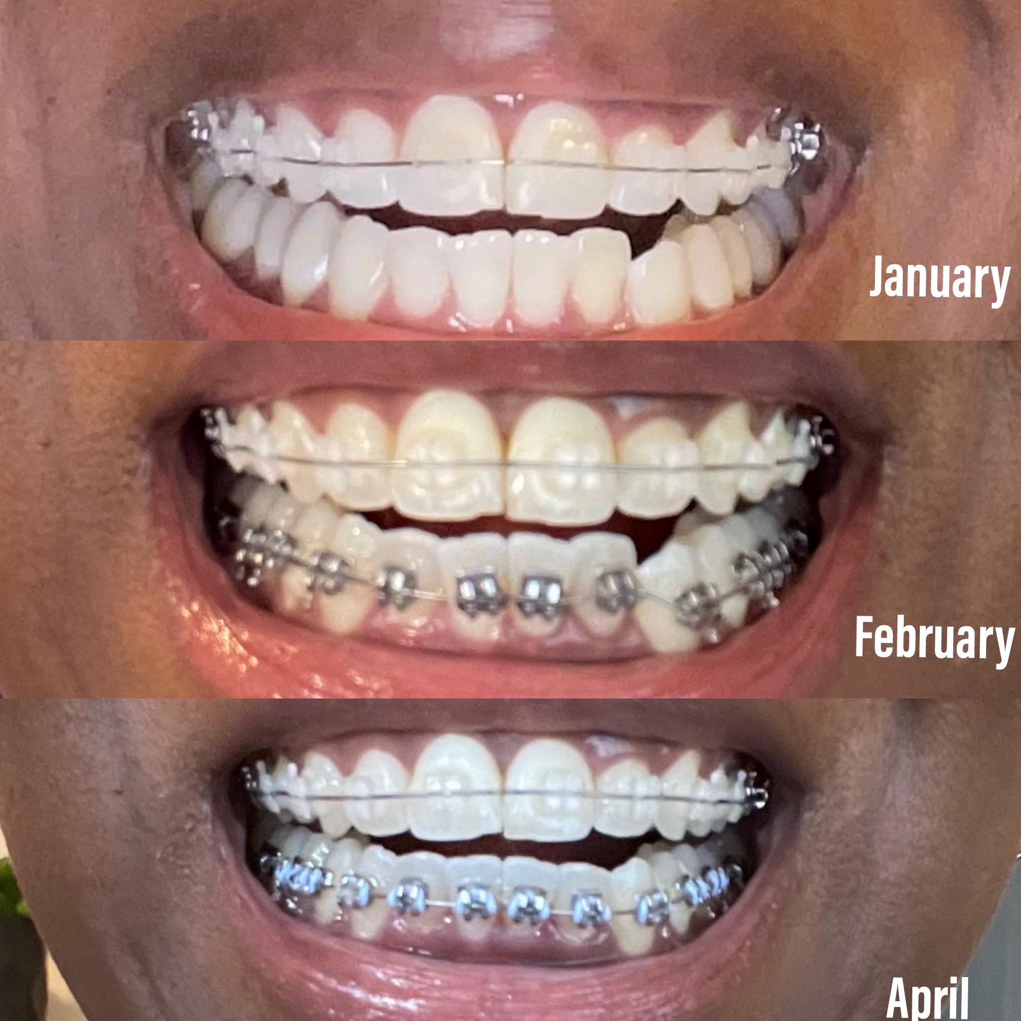 Bottom Row is Moving! : braces