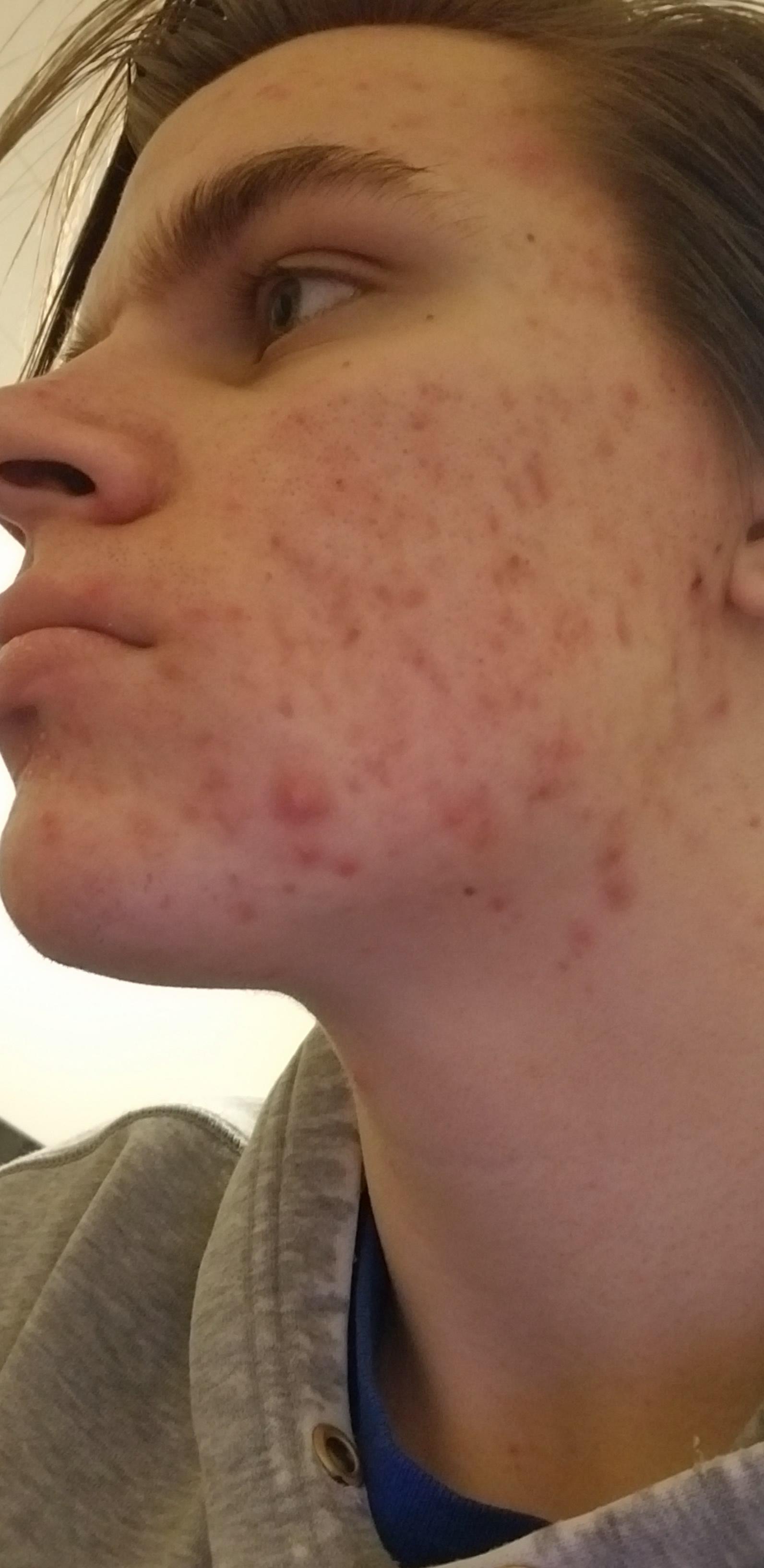 What are some basic skin care routines? I dont know much about acne