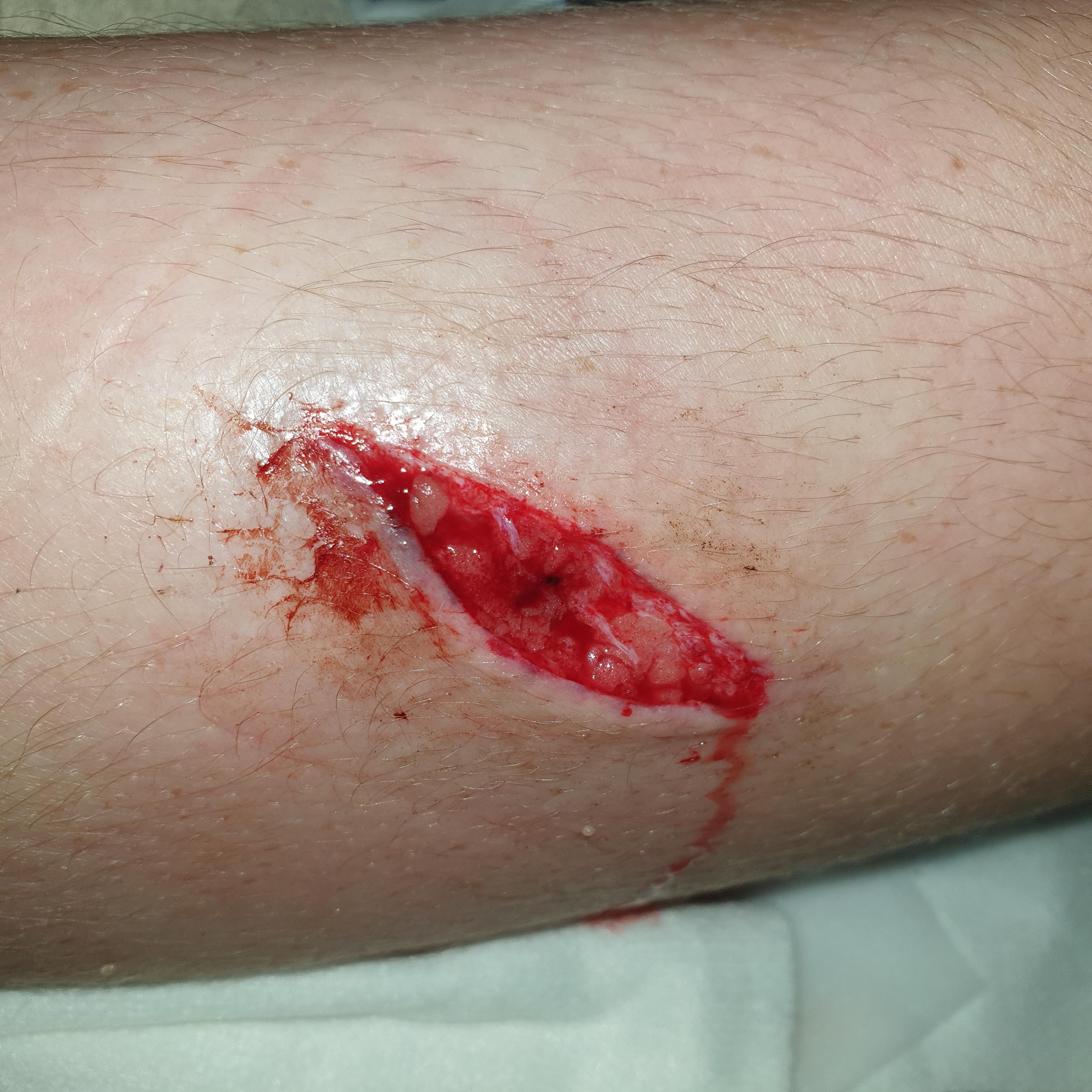 Cut my leg on a chair had to get stitches InjuriesAndWounds