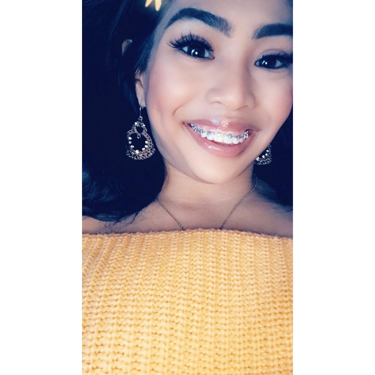 Got my braces tightened today. Getting them off in 3 months 😁 r/braces