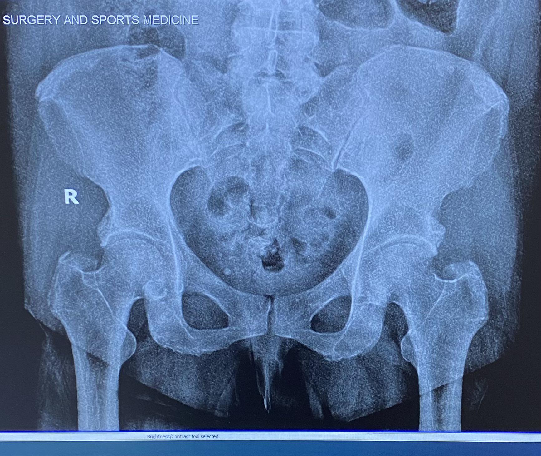 Xray of my hips. Went in for persistent right hip pain and came out with trochanter bursitis. I
