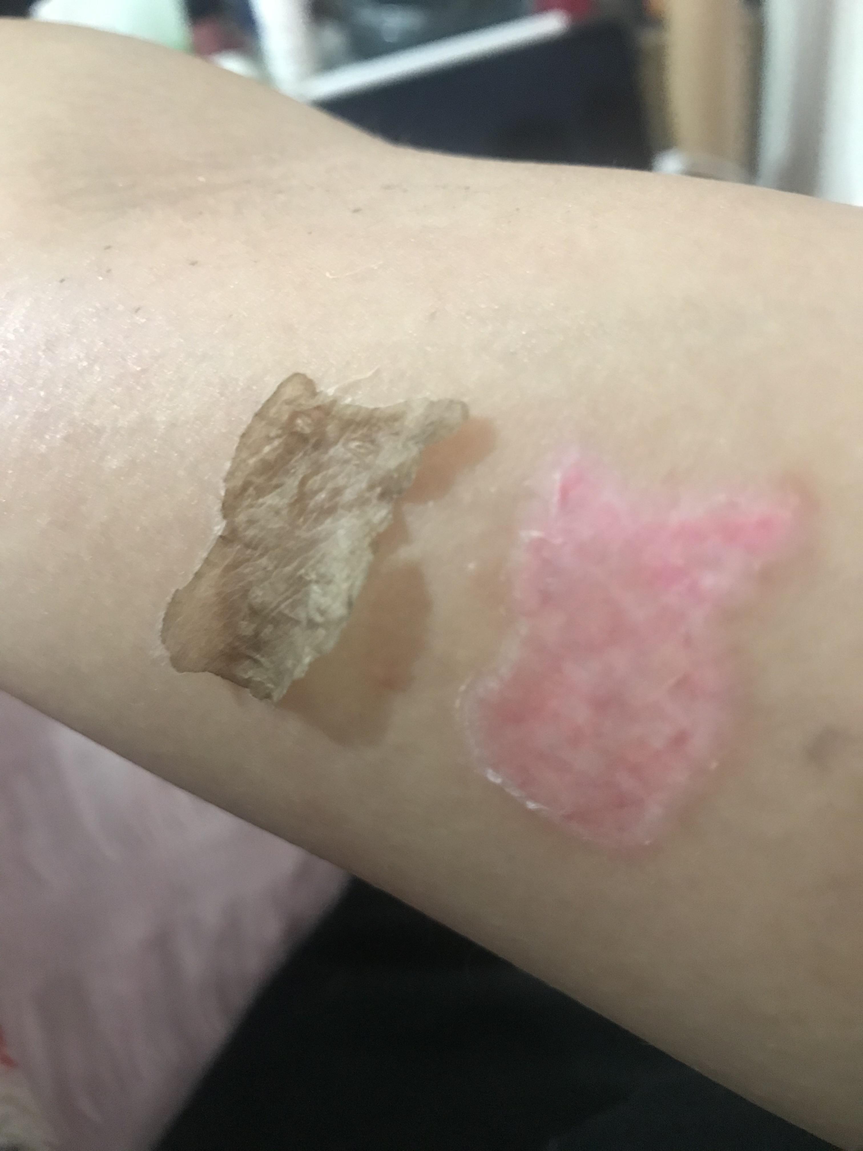 Laser tattoo removal on red ink r/peeling