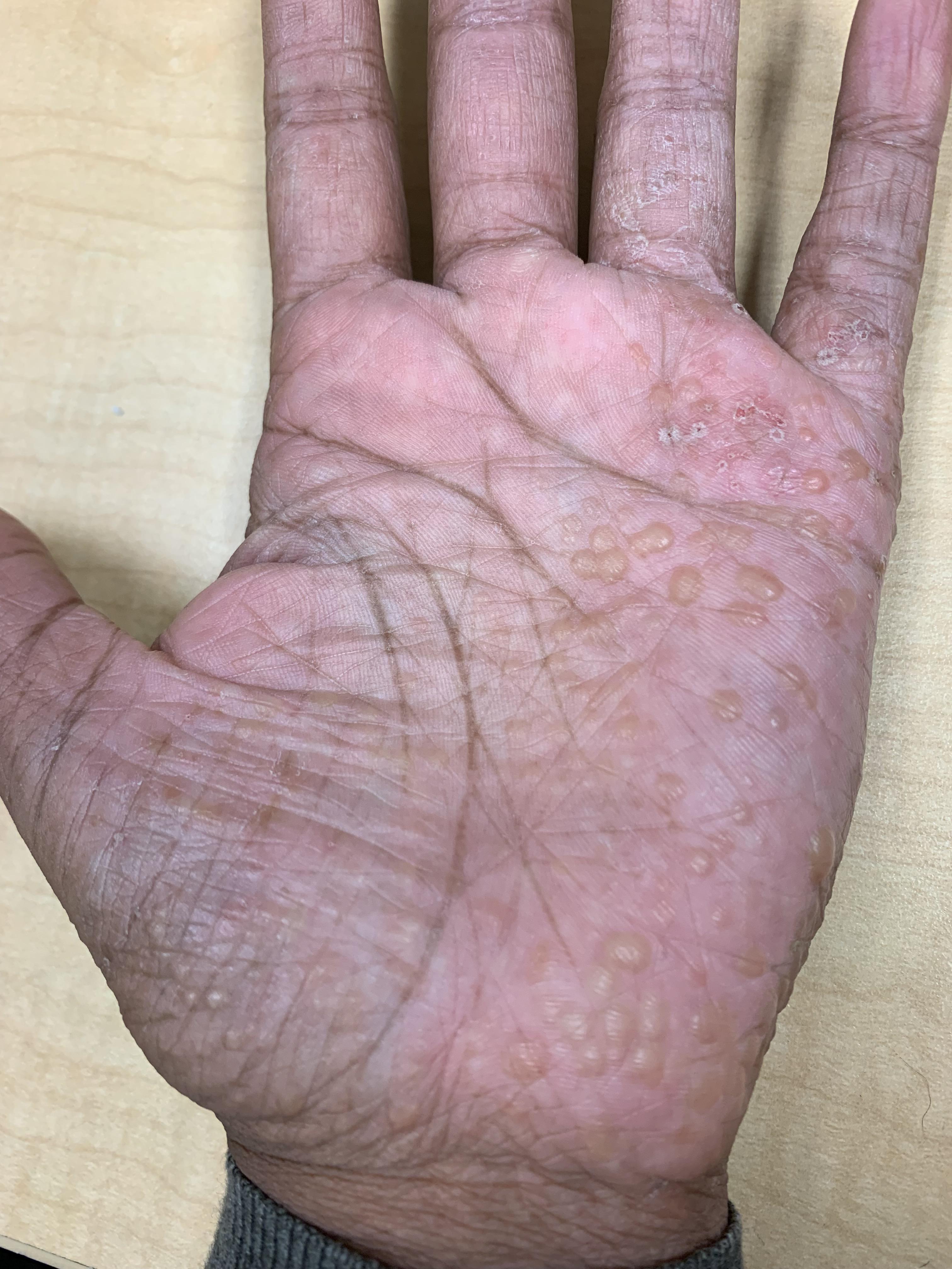 Almost a year ago you guys helped me identify this as dyshidrotic