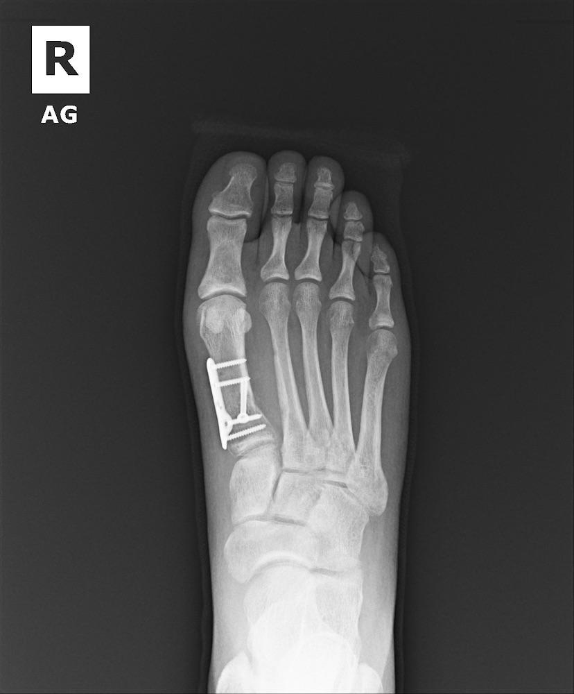 Xray for bunionectomy and first metatarsal osteotomy r/bunions