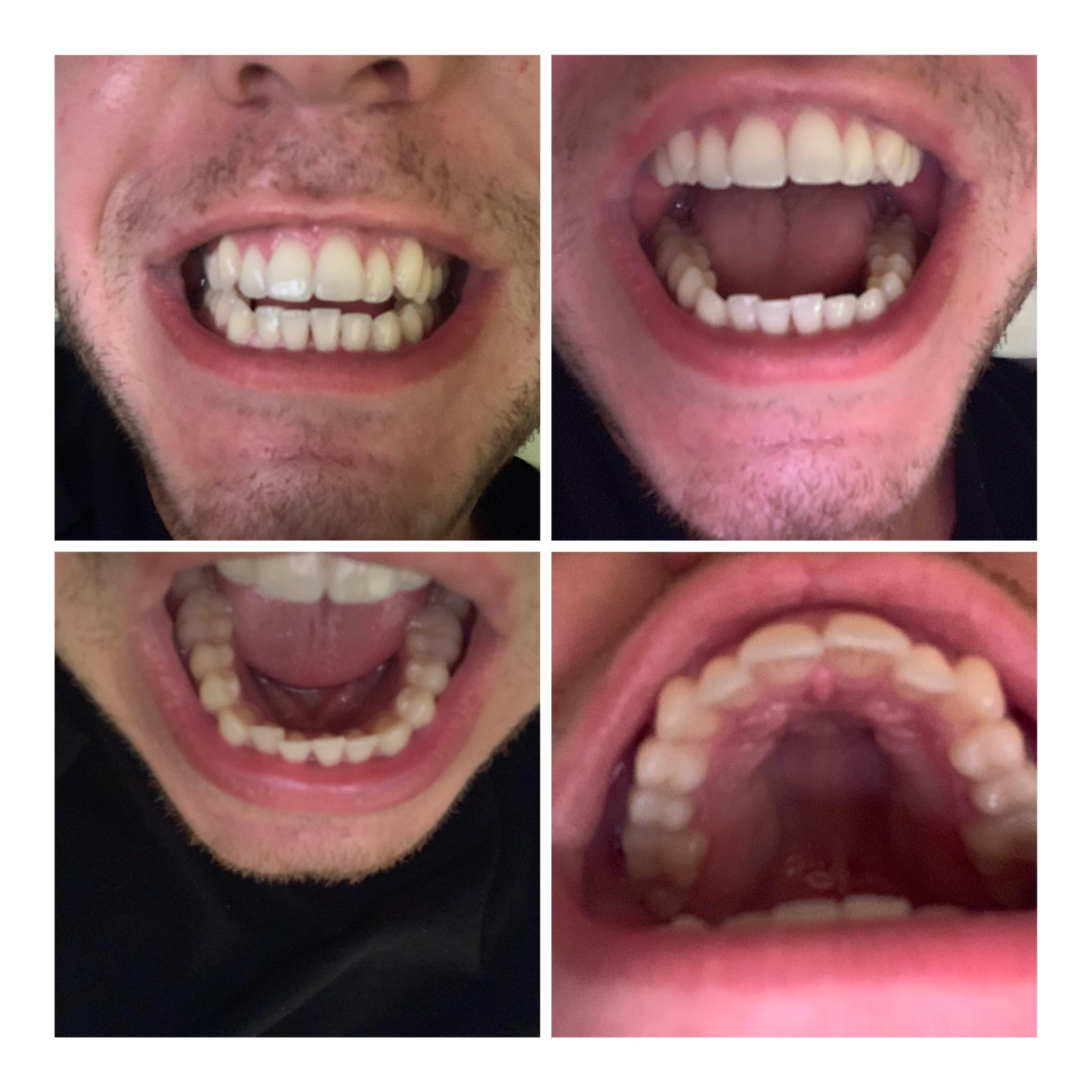 How Old Do You Have to Be to Get Invisalign? Bates.