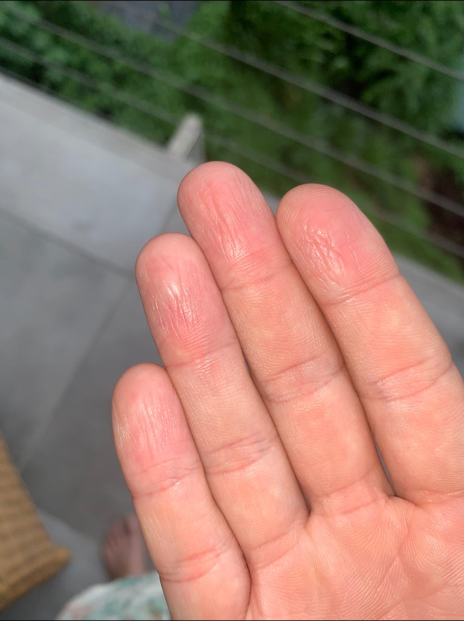 burning sensation +lost feeling +got marks on fingers what can it be