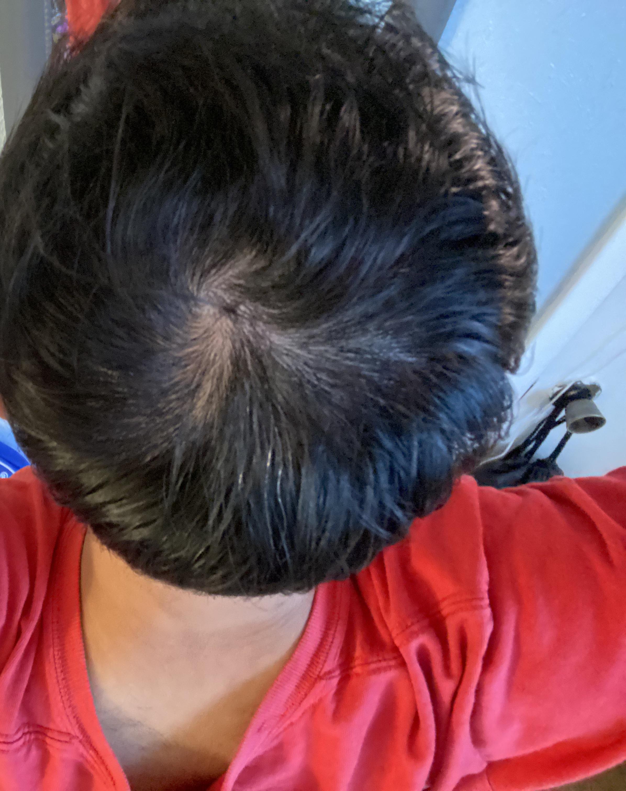 Getting paranoid but probably for good reason, guys/gals am I balding