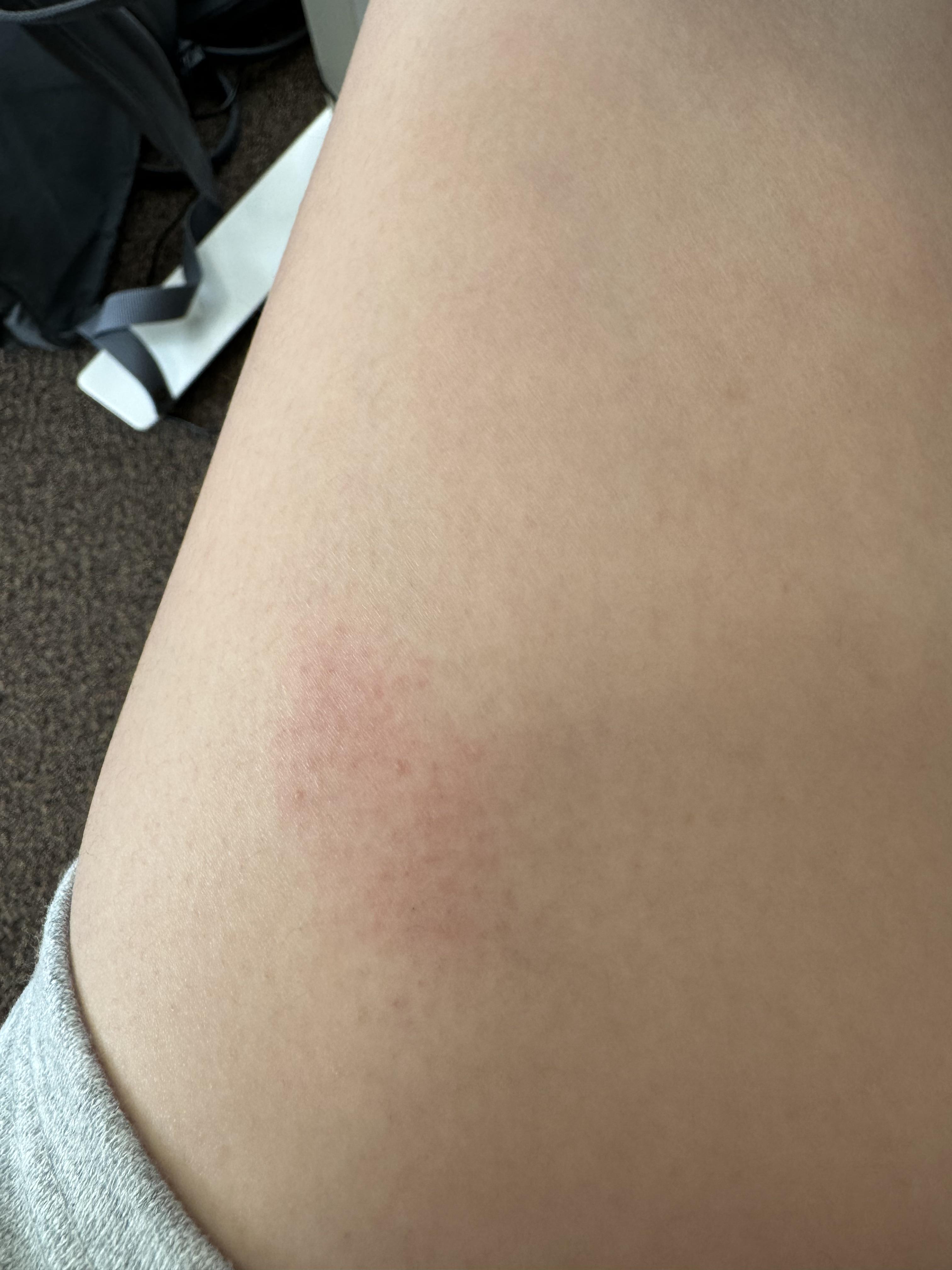 B12 injection site red and itchy r/DIYCosmeticProcedures