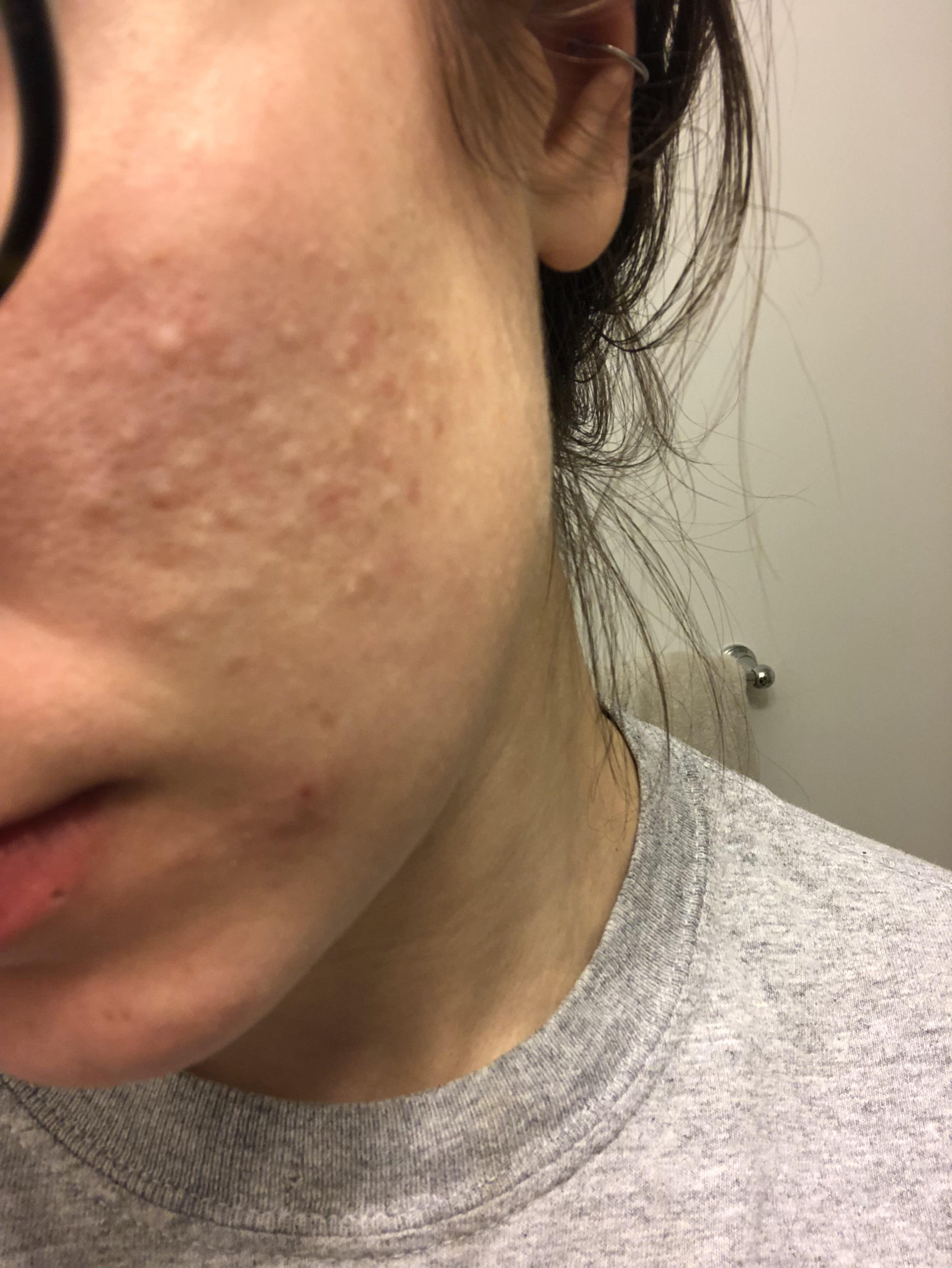 Help with pusfilled bumps on cheek! r/acne