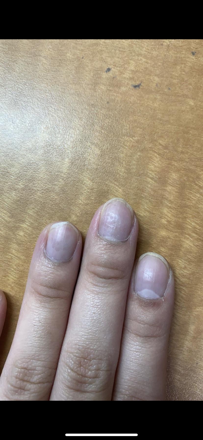 Don’t know why my middle finger nails look like that, it has little