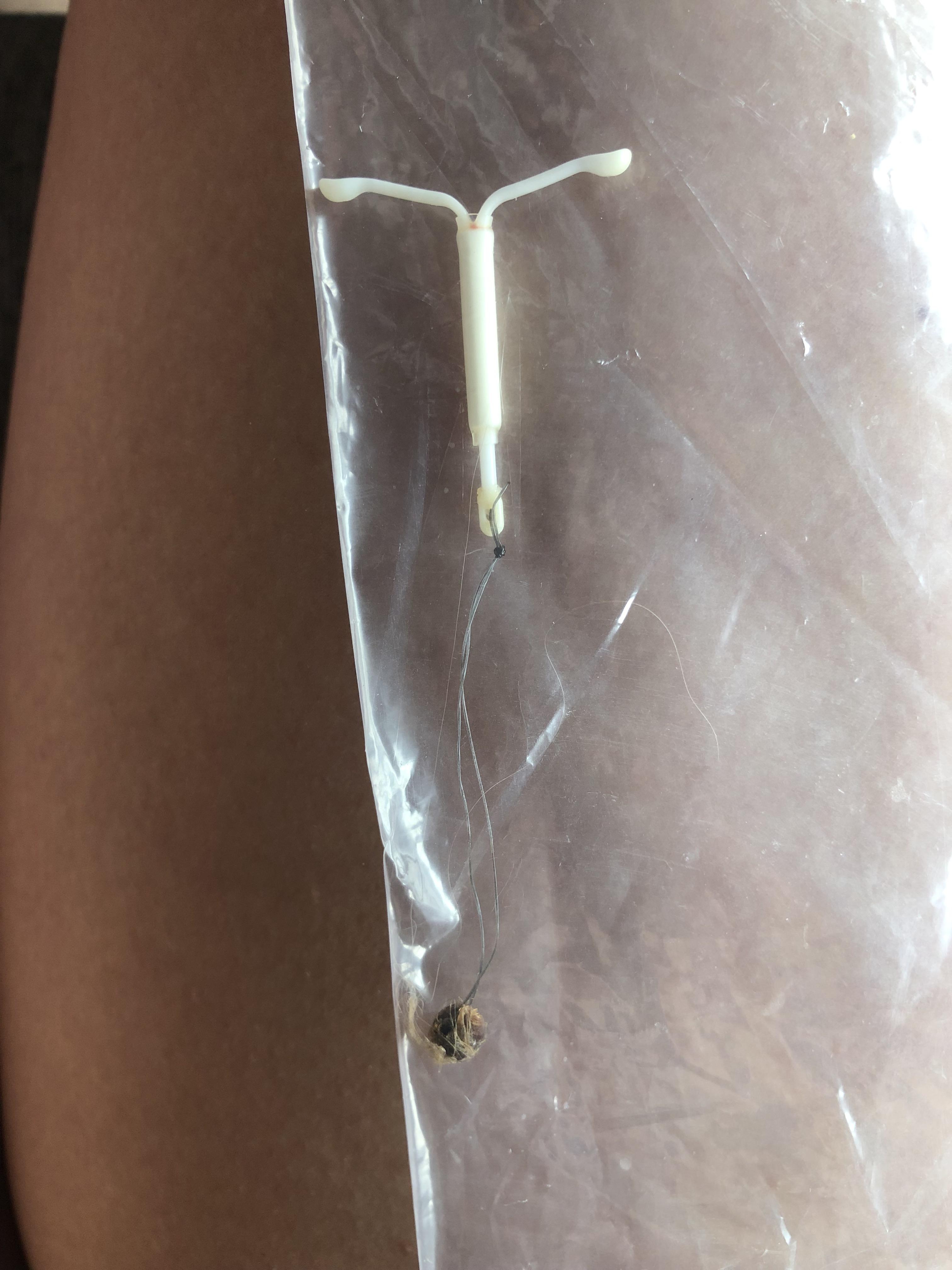 Mirena expulsion after 3 years. Giant hair all attached to the strings