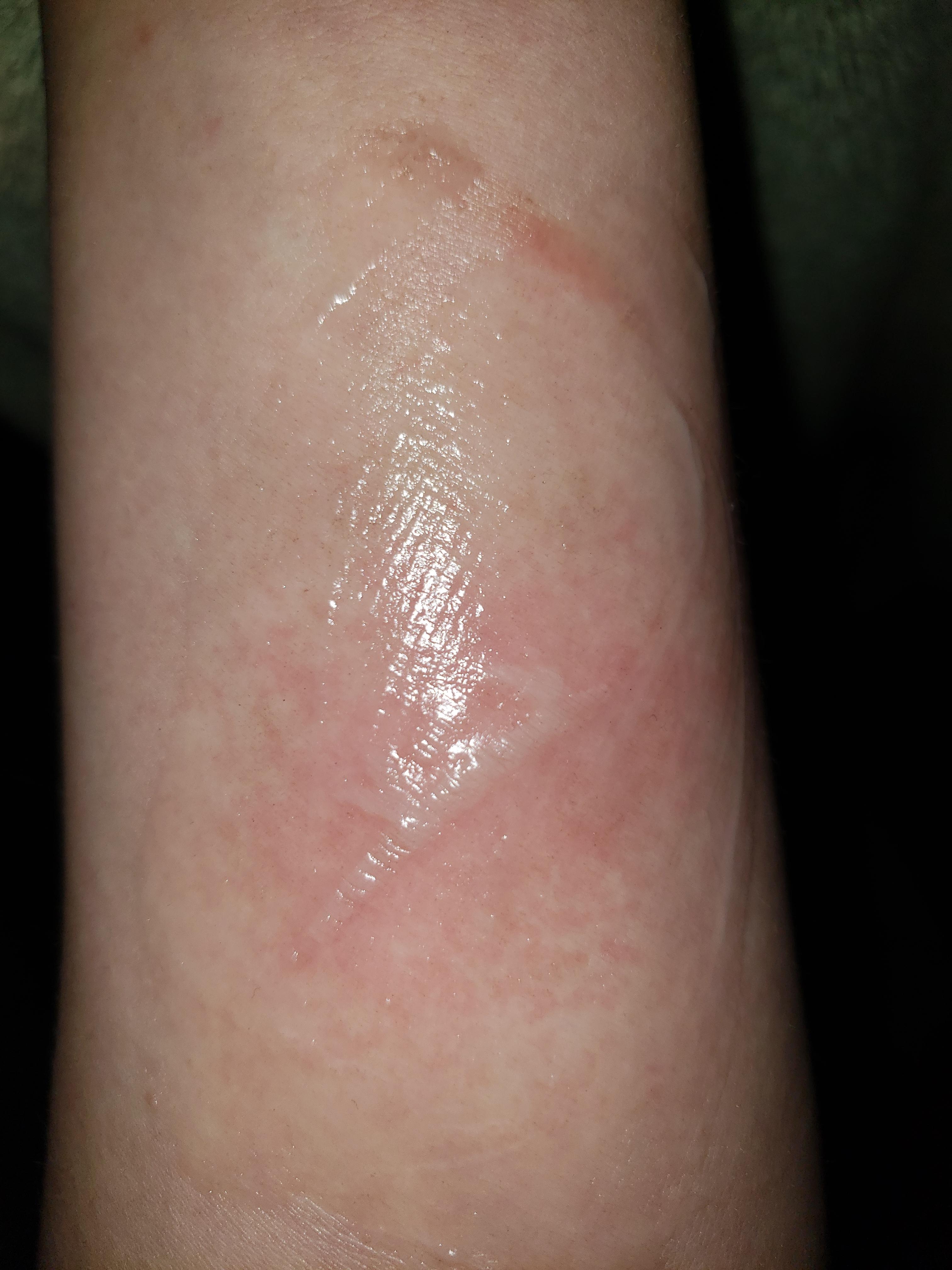 My first battle scar from blacksmithing a week in lol r/Blacksmith