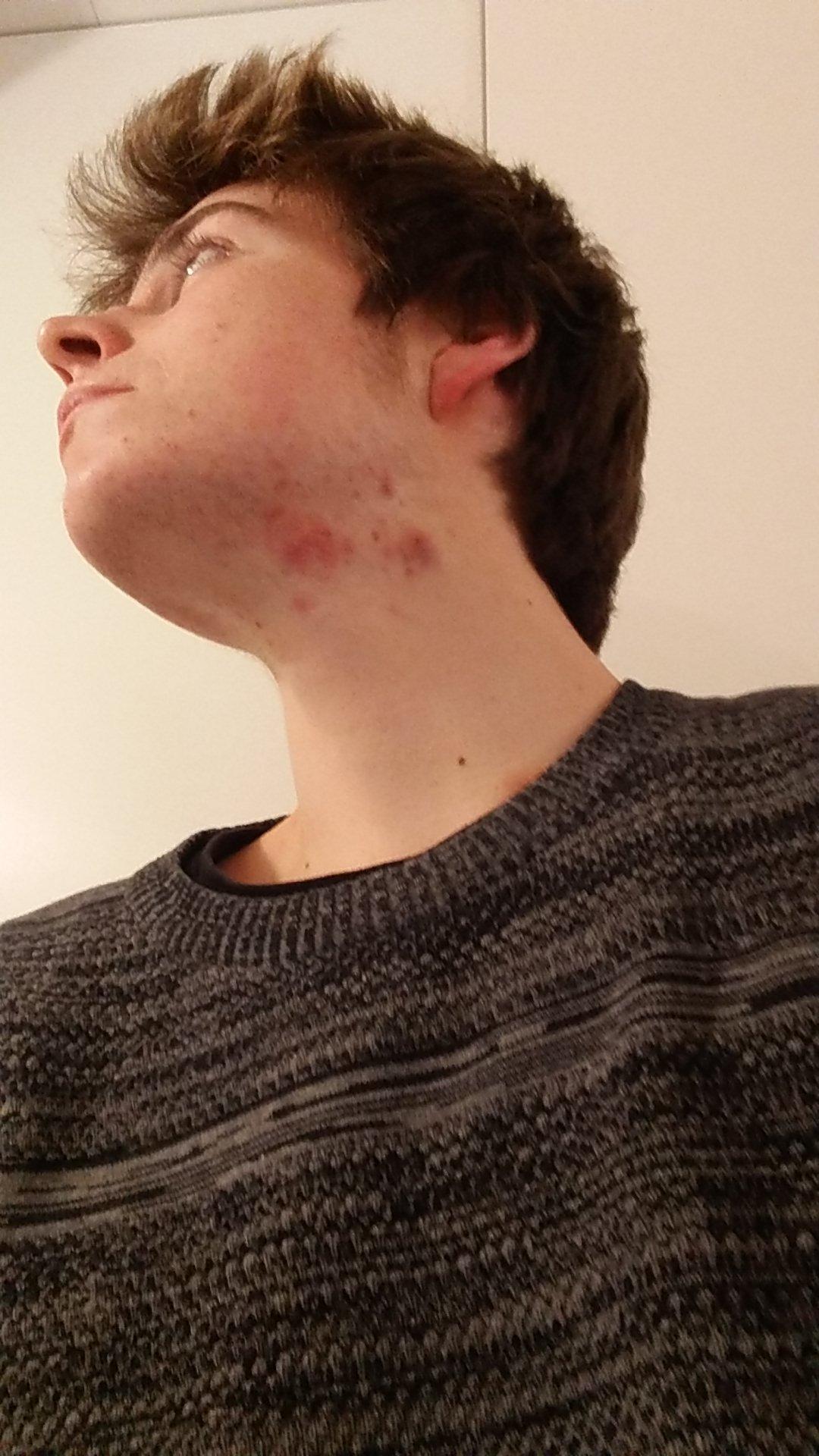 how to prevent a violin hickey? it drives me crazy and is ery painful