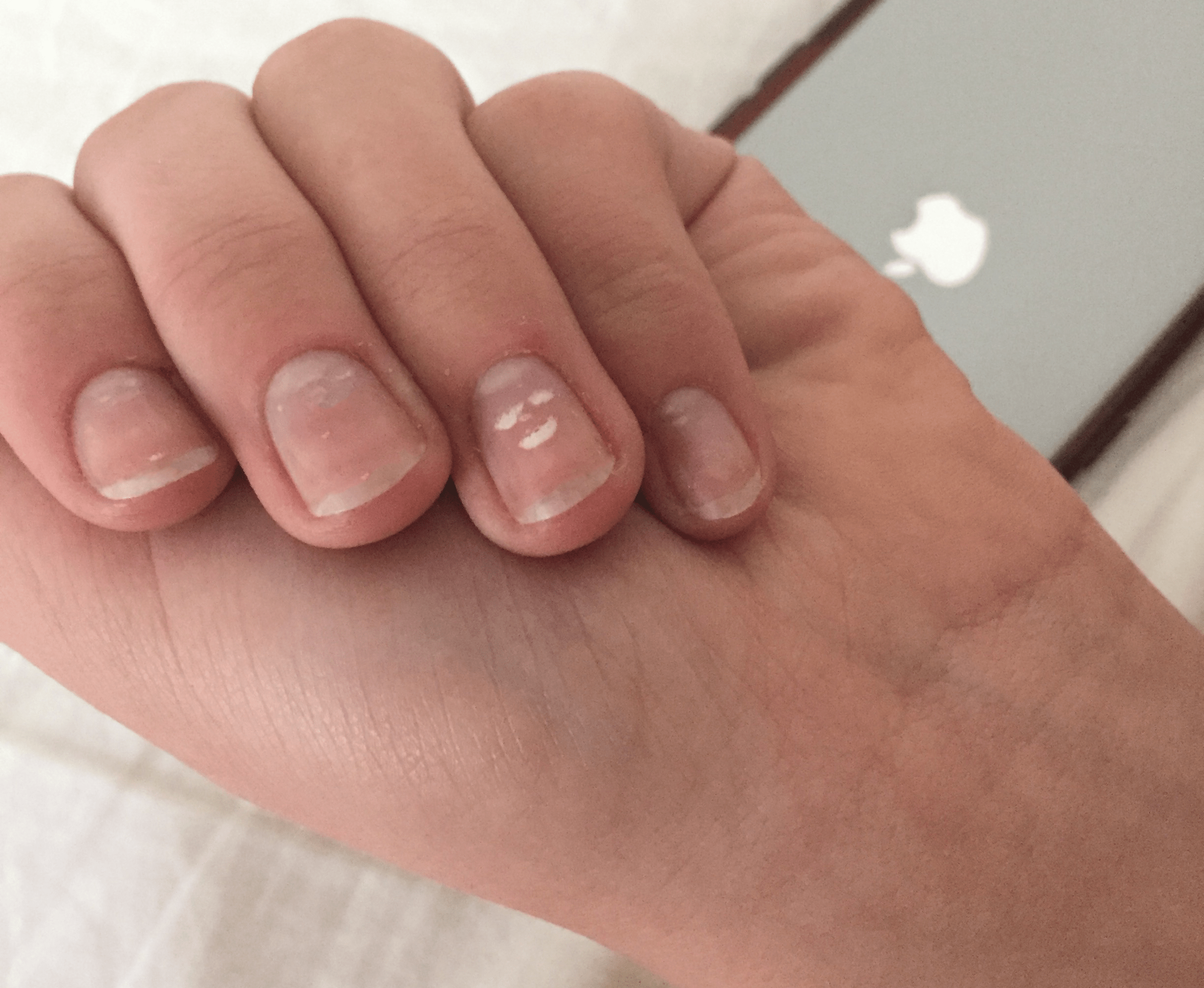 Top 124+ white spots on nails reddit best ceg.edu.vn