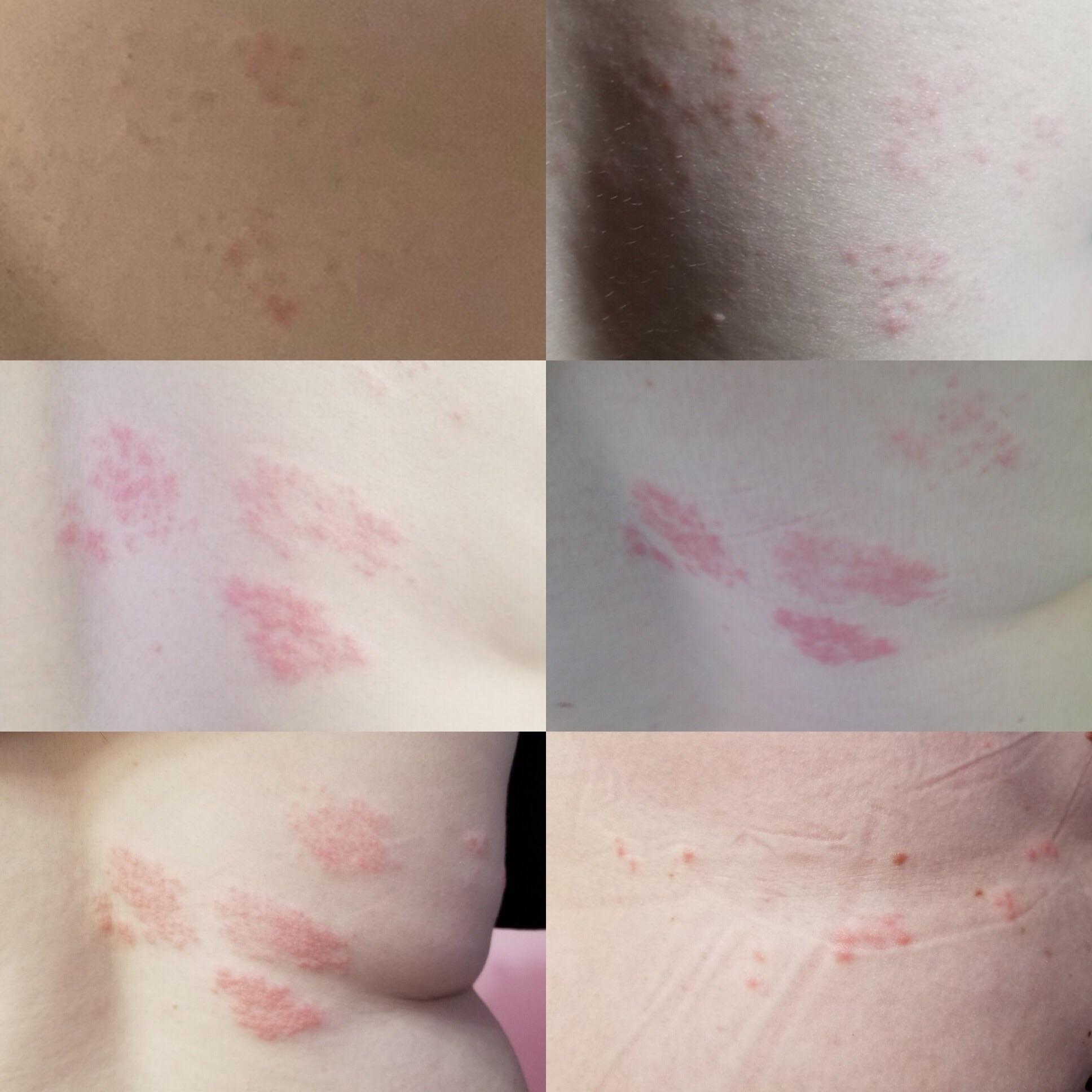 The progression of shingles over the last two weeks. Started out on my