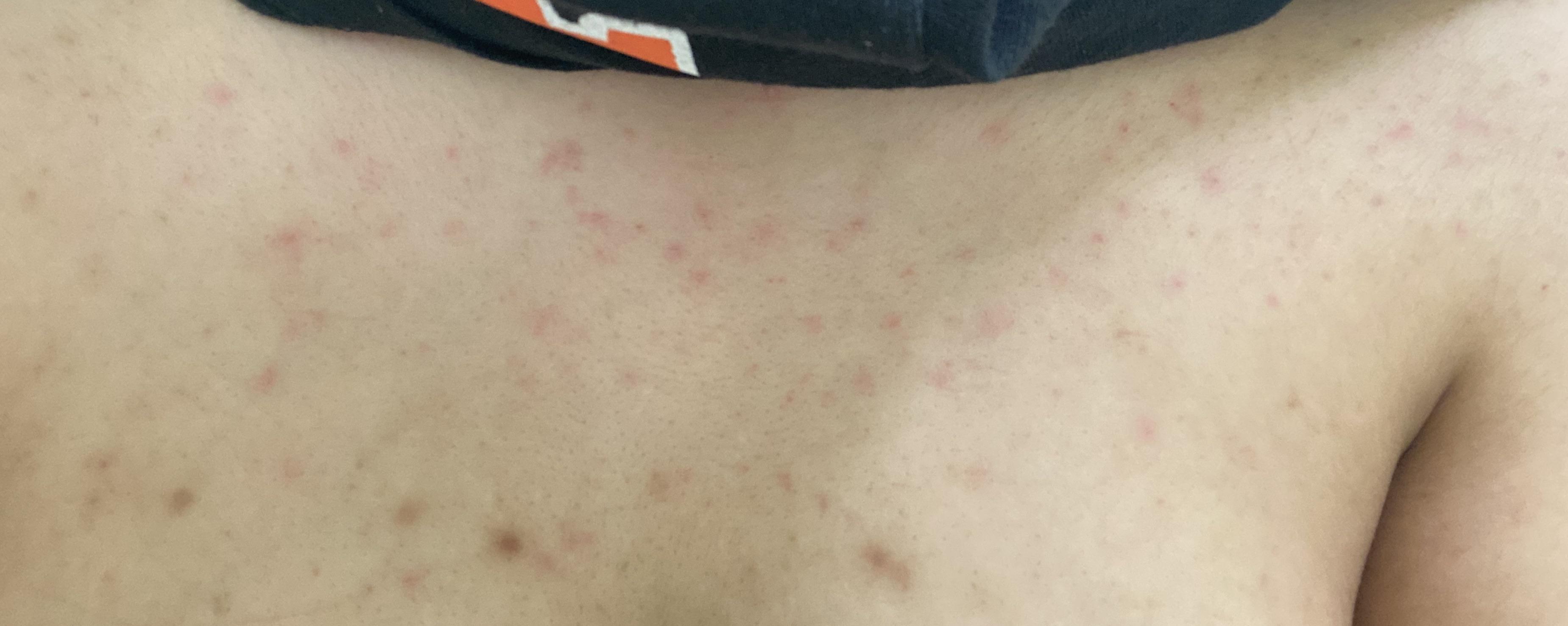 [Skin Concern] Folliculitis/fungal on my chest wont go away. After I