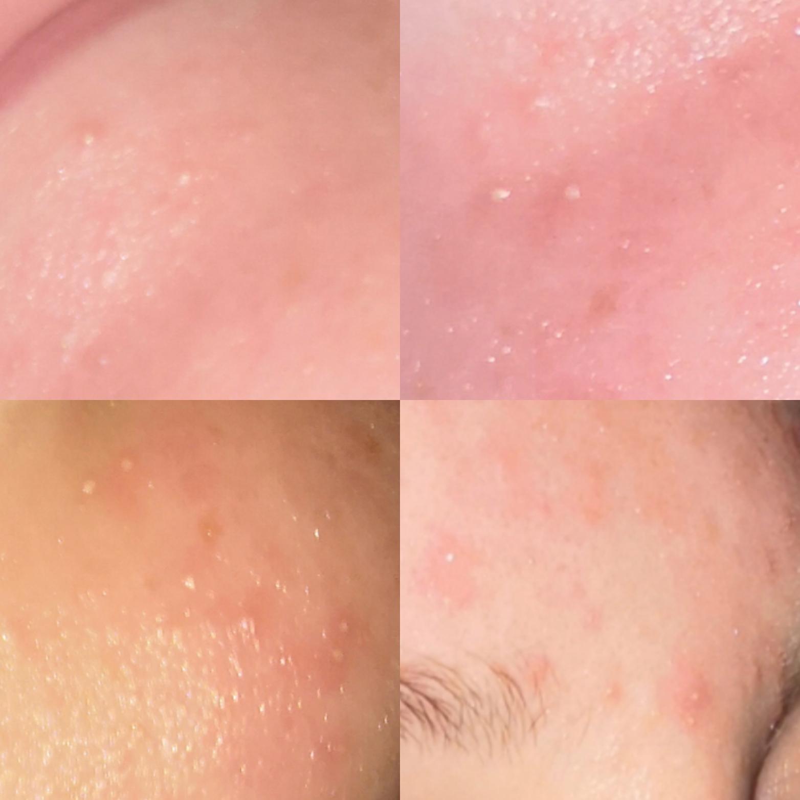 Ivermectin Rosacea / Chemical Peels for Acne and Anti Aging FDA Approves Ivermectin (ivm