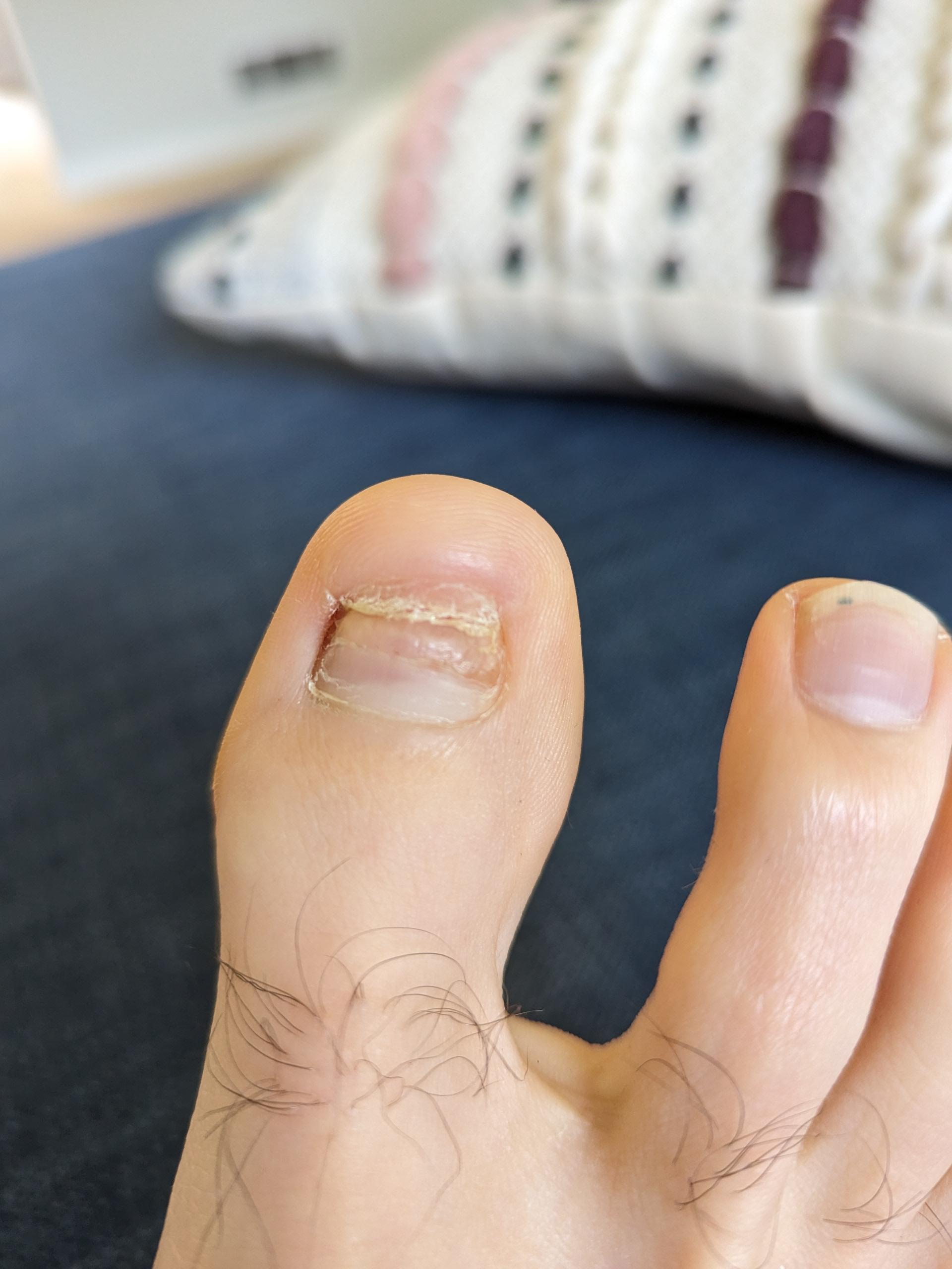 Full nail avulsion pain after 4 months r/Ingrown_Toenails