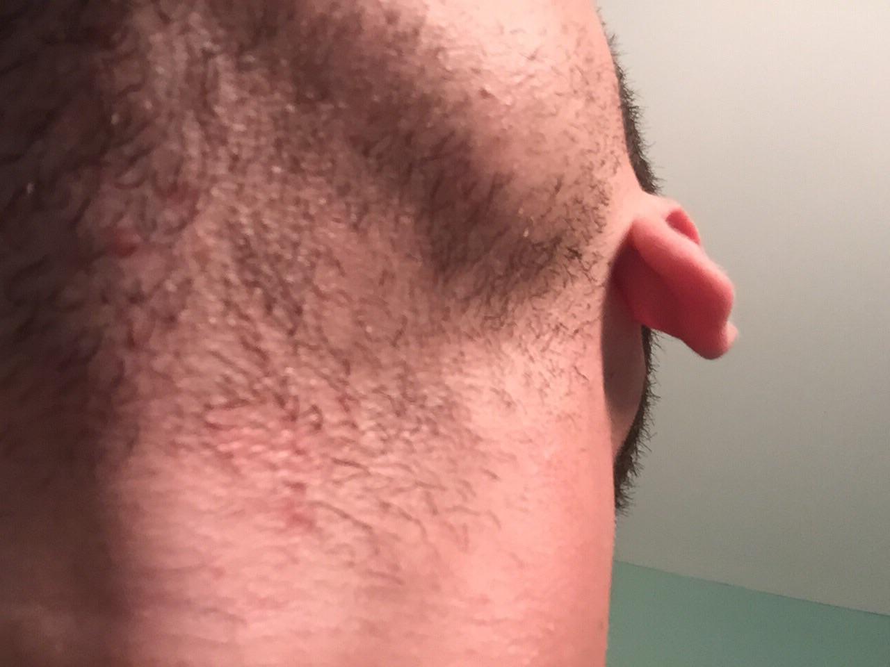 How To Get Rid Of Ingrown Hairs On Neck / Razor Bumps And Ingrown Hair