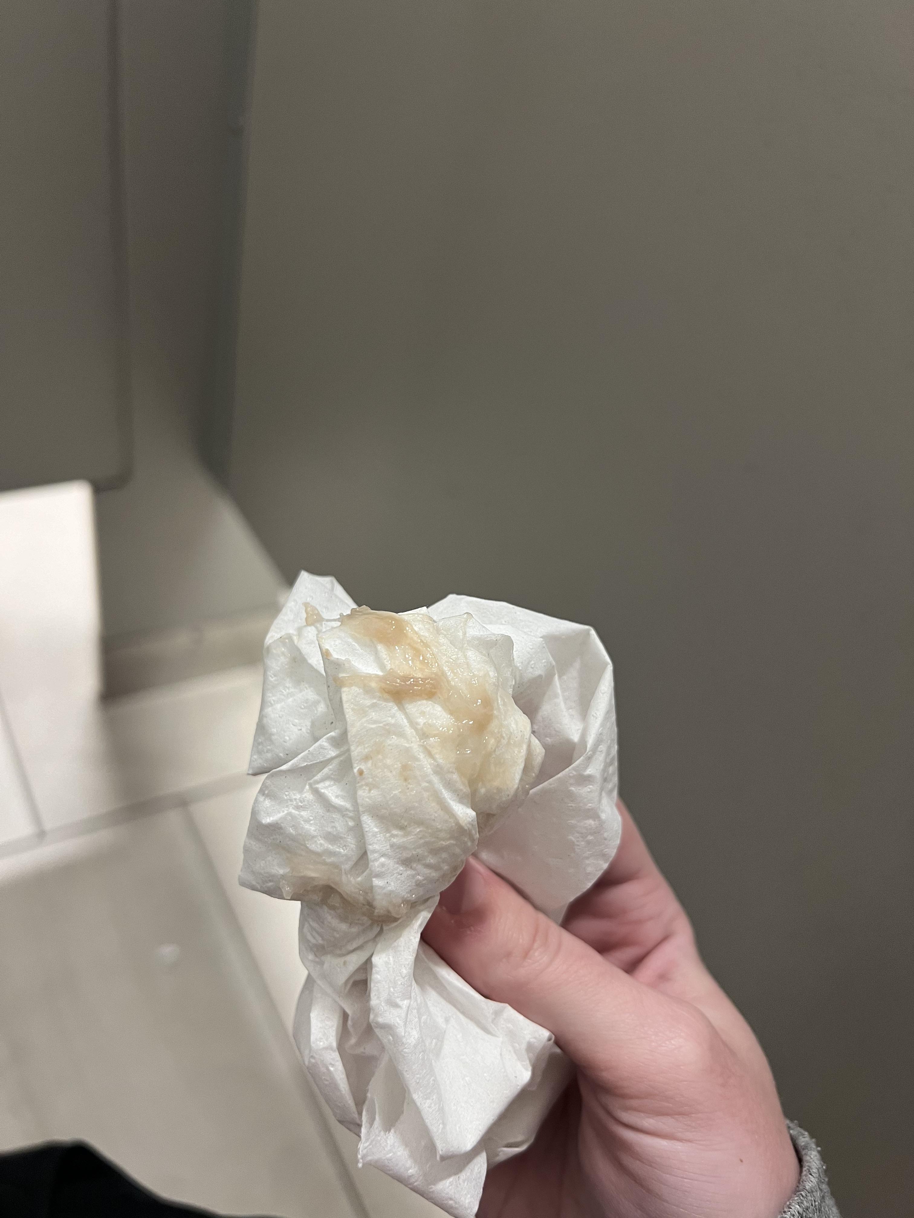 Chunky discharge r/menstruation