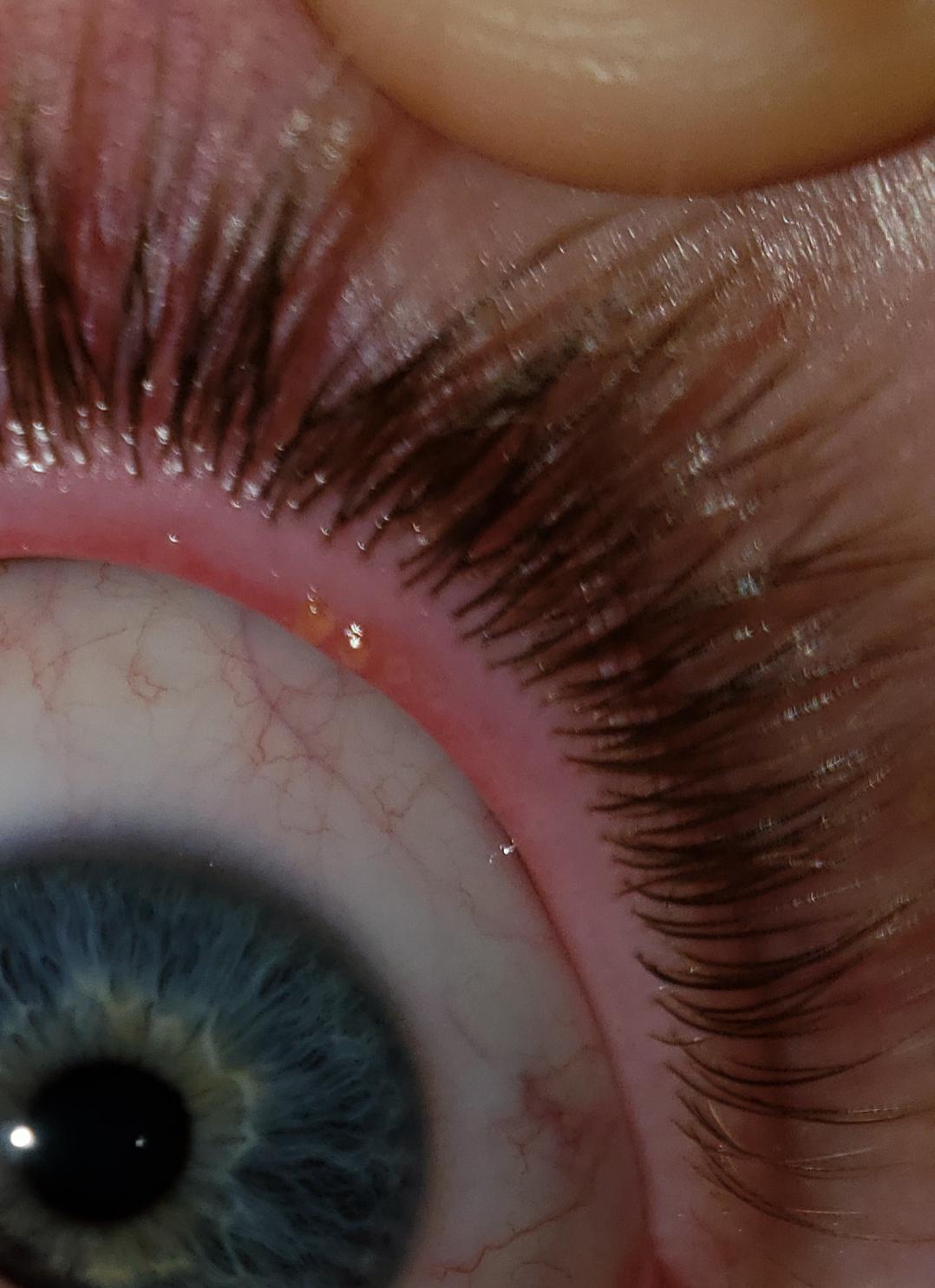 What are these on my eyelid?, they feel like sand on my eyes when I